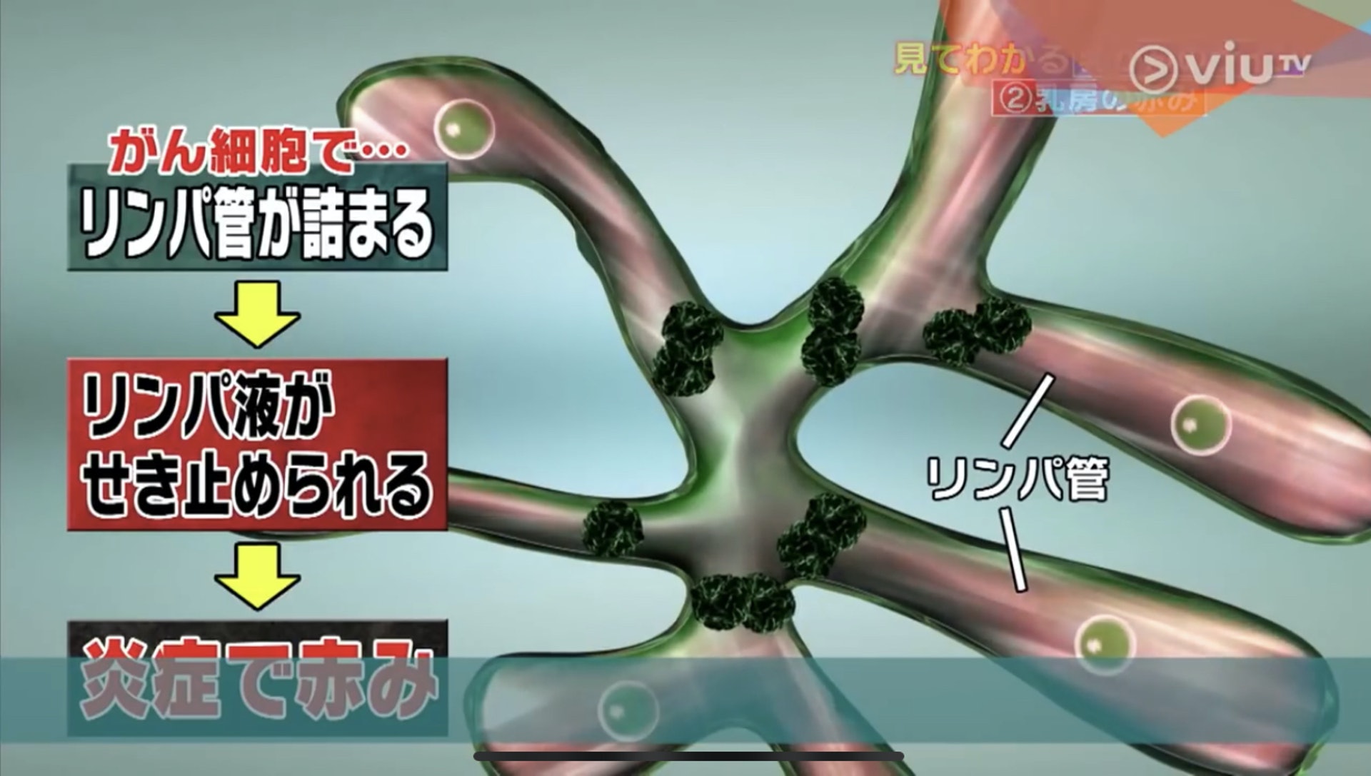 紅疹正是源於癌細胞阻塞淋巴腺,淋巴液不流通,導致發炎。(Viu TV《恐怖醫學》影片截圖) 紅疹正是源於癌細胞阻塞淋巴腺,淋巴液不流通,導致發炎。(Viu TV《恐怖醫學》影片截圖)