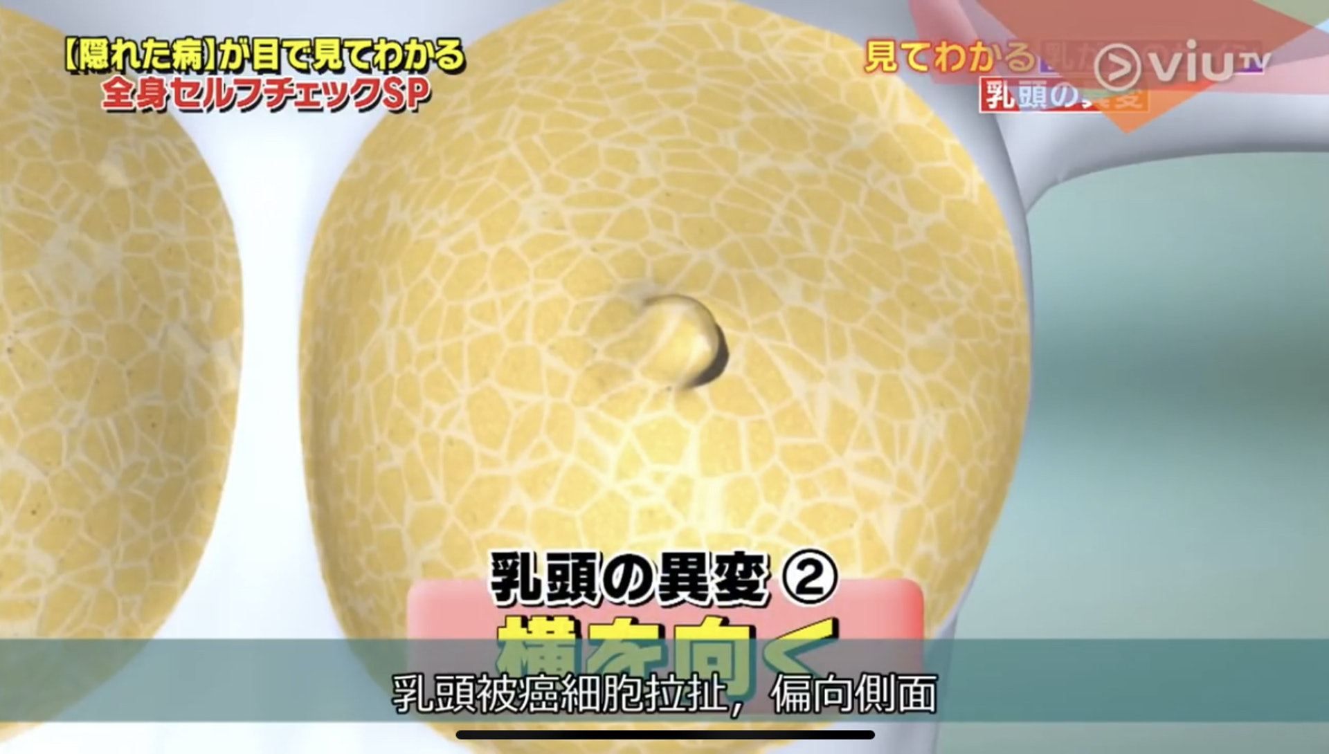 乳頭異變還可以是向橫斜。(Viu TV《恐怖醫學》影片截圖) 乳頭異變還可以是向橫斜。(Viu TV《恐怖醫學》影片截圖)