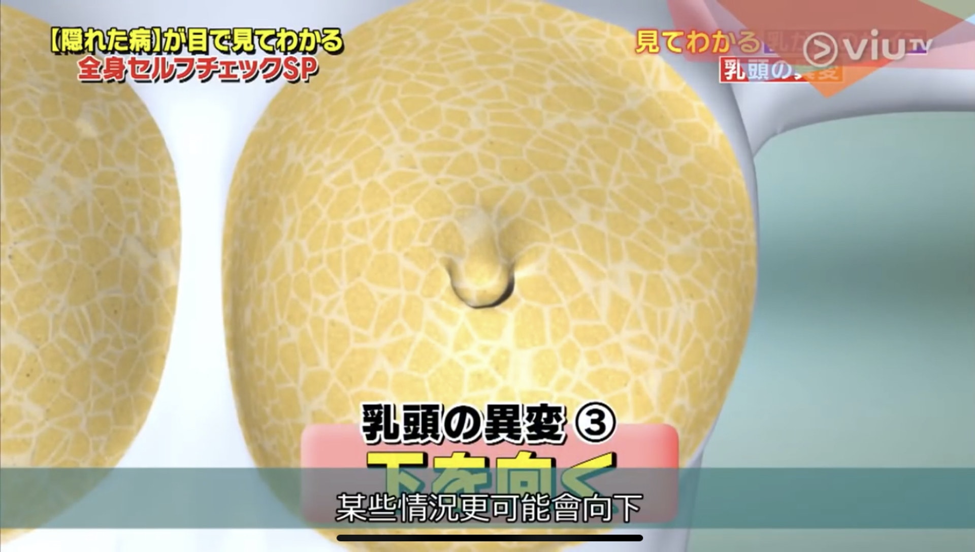 乳頭下垂都是異變可能性。(Viu TV《恐怖醫學》影片截圖) 乳頭下垂都是異變可能性。(Viu TV《恐怖醫學》影片截圖)