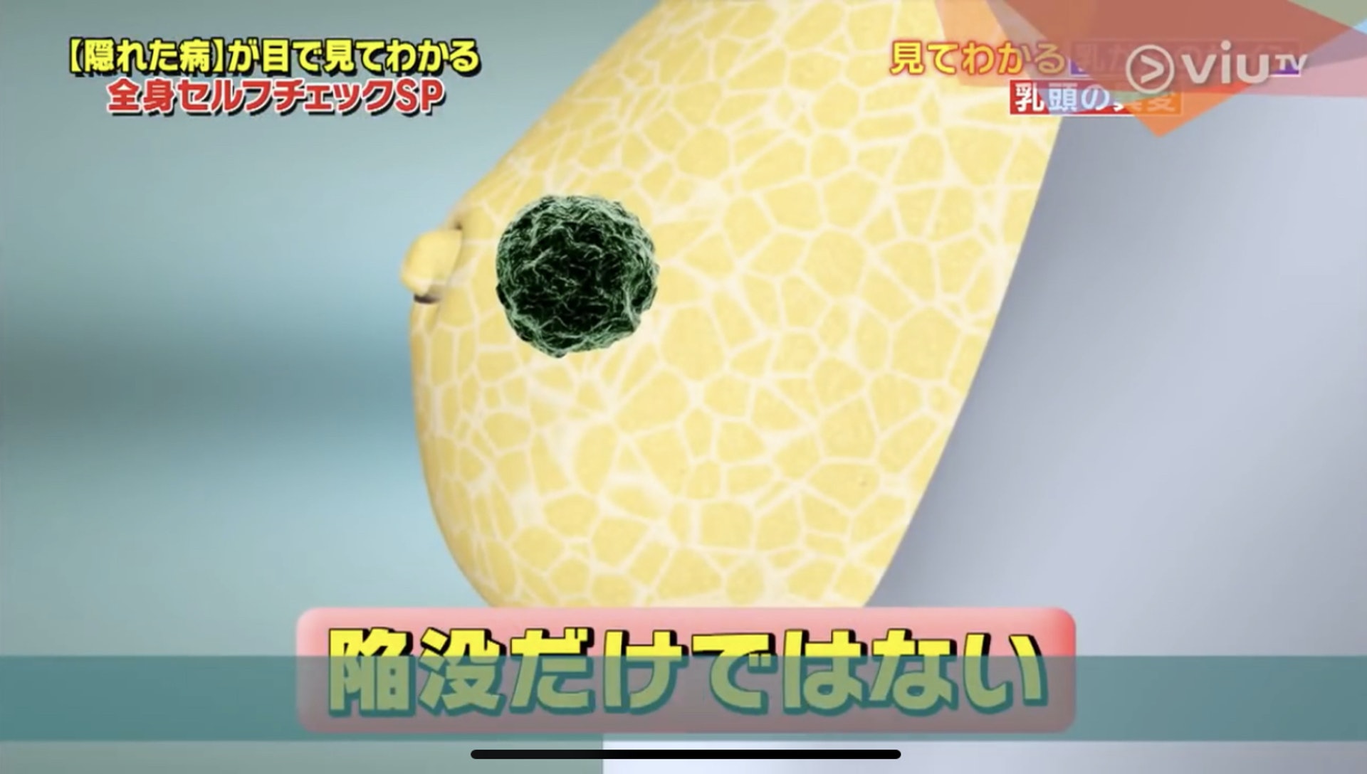 土井醫生指出,當癌細胞在乳頭後方拉扯,就會造成乳頭異變,其中一個情況就是向內凹。(Viu TV《恐怖醫學》影片截圖) 土井醫生指出,當癌細胞在乳頭後方拉扯,就會造成乳頭異變,其中一個情況就是向內凹。(Viu TV《恐怖醫學》影片截圖)