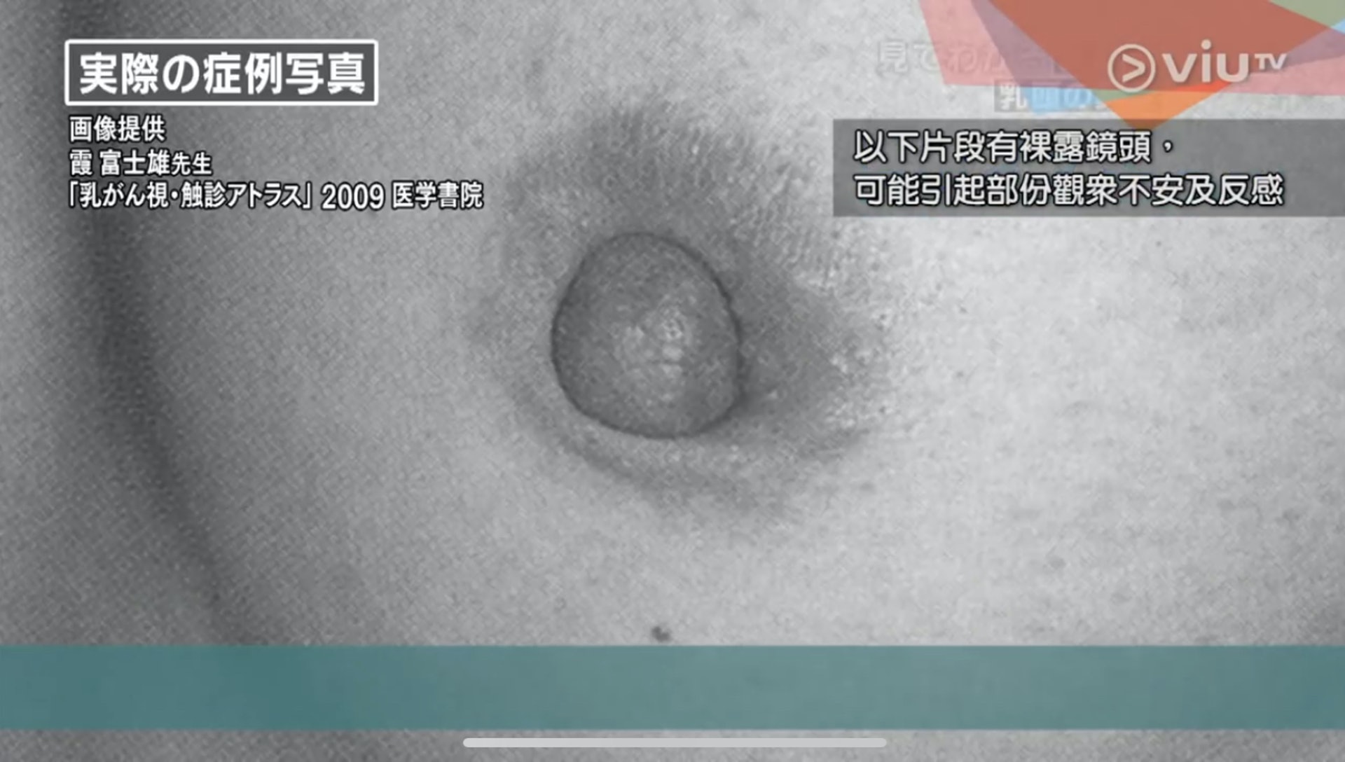乳頭向內凹的真實情況(Viu TV《恐怖醫學》影片截圖) 乳頭向內凹的真實情況(Viu TV《恐怖醫學》影片截圖)