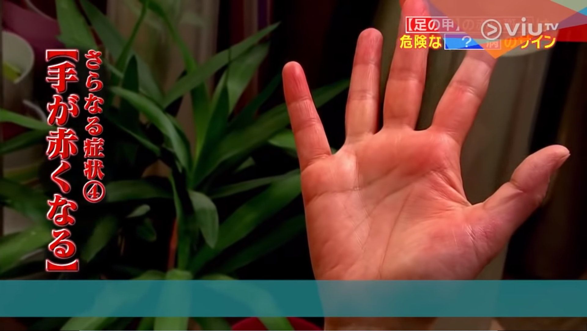 之後就連手也開始發紅(Viu TV《恐怖醫學》影片截圖) 之後就連手也開始發紅(Viu TV《恐怖醫學》影片截圖)