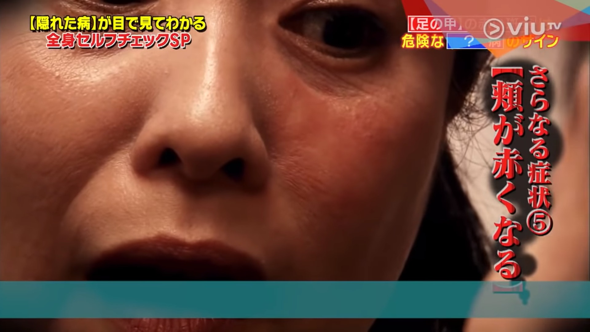 紅斑甚至進一步蔓延到臉上。(Viu TV《恐怖醫學》影片截圖) 紅斑甚至進一步蔓延到臉上。(Viu TV《恐怖醫學》影片截圖)