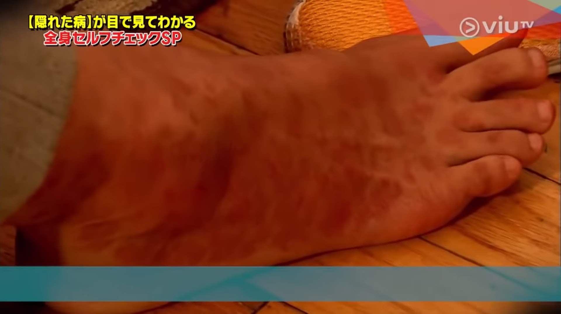 紅斑最終可以佈滿整個足部。(Viu TV《恐怖醫學》影片截圖) 紅斑最終可以佈滿整個足部。(Viu TV《恐怖醫學》影片截圖)