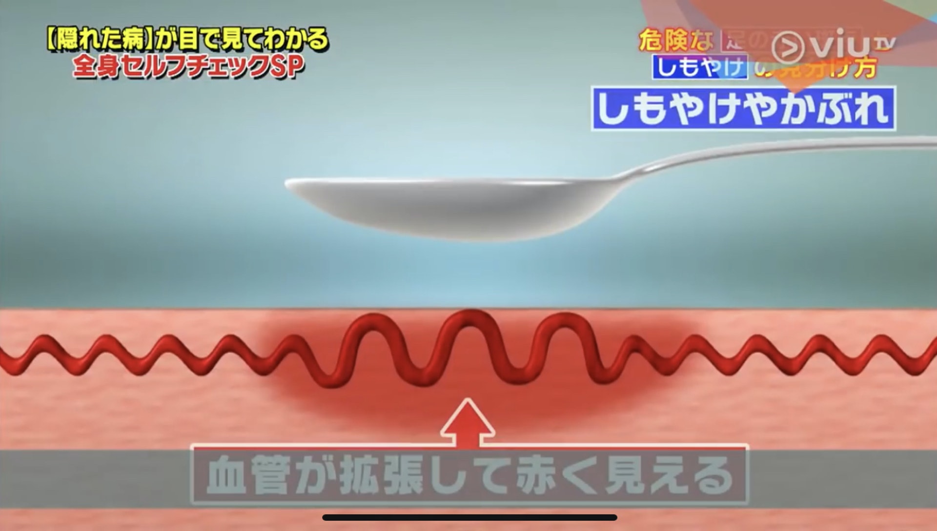 放開後血流回復又會再次變紅。(Viu TV《恐怖醫學》影片截圖) 放開後血流回復又會再次變紅。(Viu TV《恐怖醫學》影片截圖)
