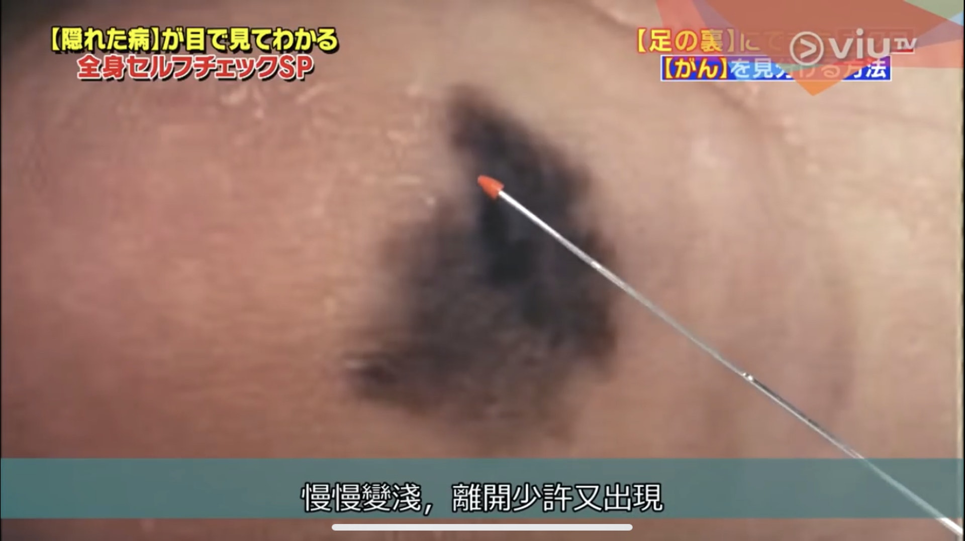 北島醫生表示,此圖的痣已算惡化後偏黑的情況,但仍可割除處理。(Viu TV《恐怖醫學》影片截圖) 北島醫生表示,此圖的痣已算惡化後偏黑的情況,但仍可割除處理。(Viu TV《恐怖醫學》影片截圖)