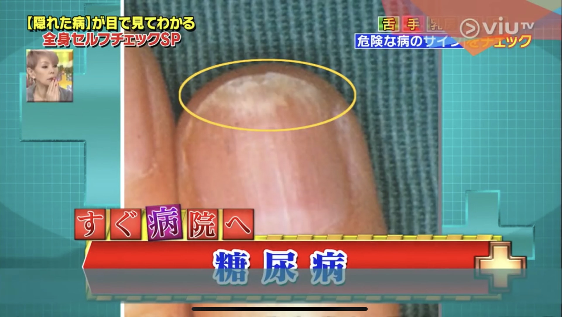 指甲前端白色的部分一直向內擴散,竟然是有機會患糖尿病!(Viu TV《恐怖醫學》影片截圖) 指甲前端白色的部分一直向內擴散,竟然是有機會患糖尿病!(Viu TV《恐怖醫學》影片截圖)