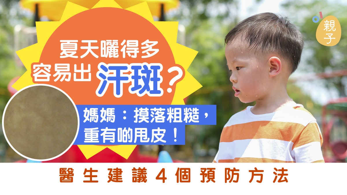 【夏日汗斑】曬得多容易出汗斑?醫生建議4個預防方法 【夏日汗斑】曬得多容易出汗斑?醫生建議4個預防方法