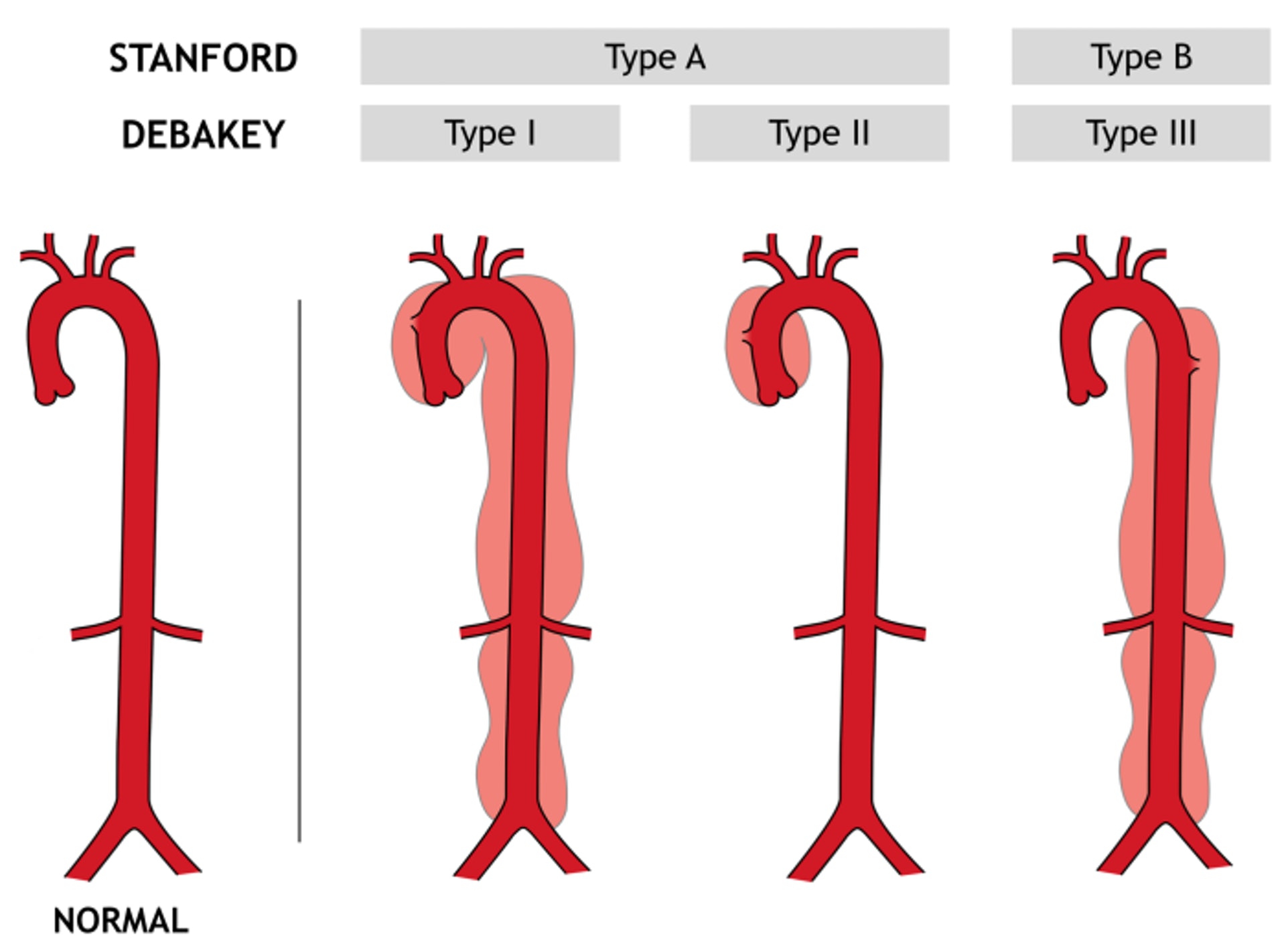 主動脈撕裂分為A、B型。（CDEM）