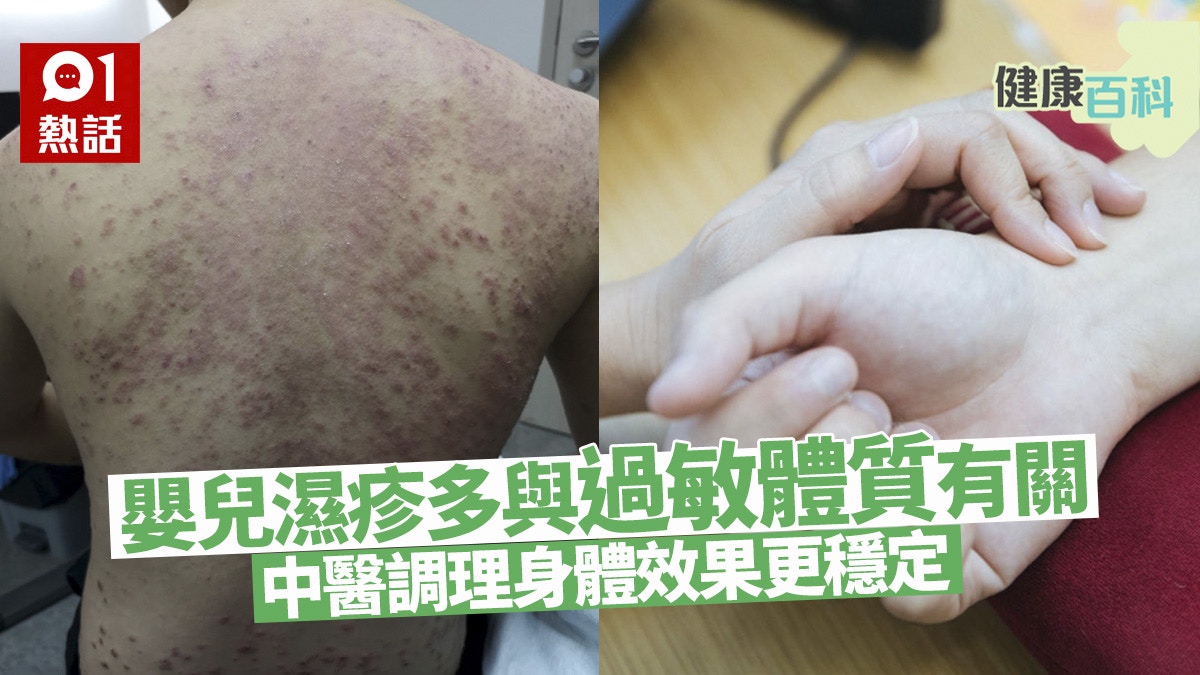健康百科｜濕疹成因有先天不足及後天飲食　中醫副作用少療效穩定