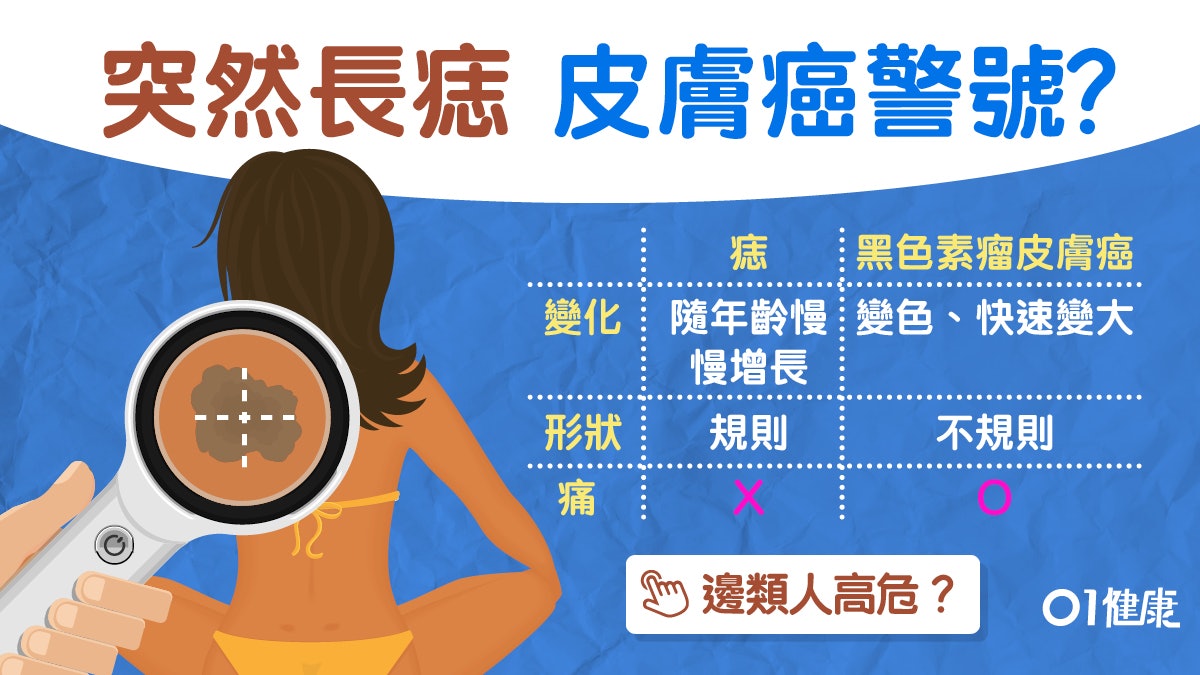 【皮膚癌】長痣小心皮膚癌!皮膚白高危教你ABCDE法則分辨痣或癌 【皮膚癌】長痣小心皮膚癌!皮膚白高危教你ABCDE法則分辨痣或癌