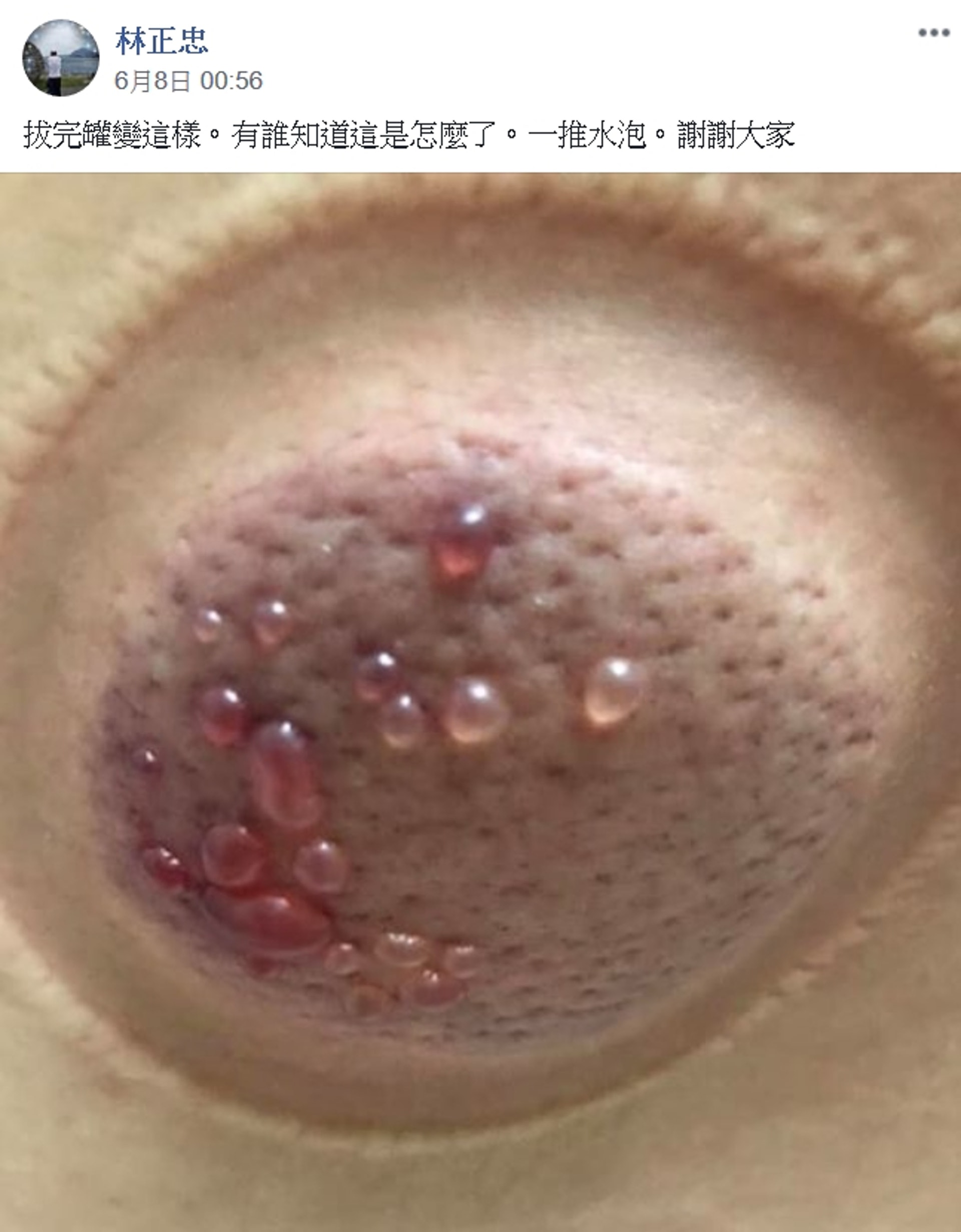 有台灣網友上傳一張拔罐後皮膚冒水泡的駭人照片。（Facebook@爆系知識家）