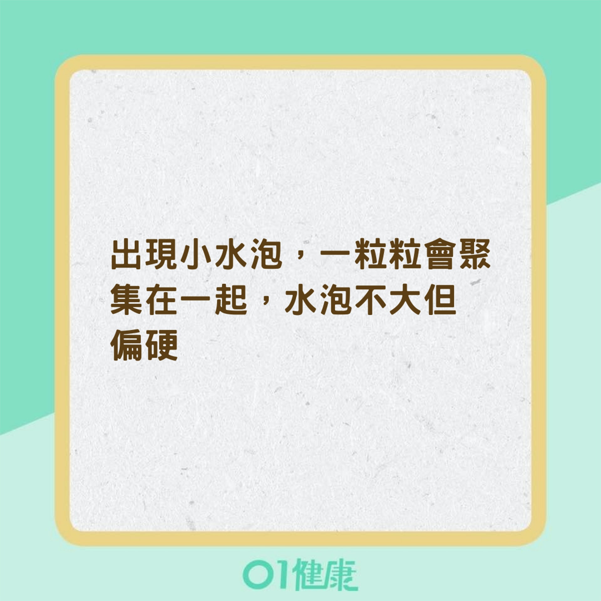 汗皰疹的症狀(01製圖) 汗皰疹的症狀(01製圖)