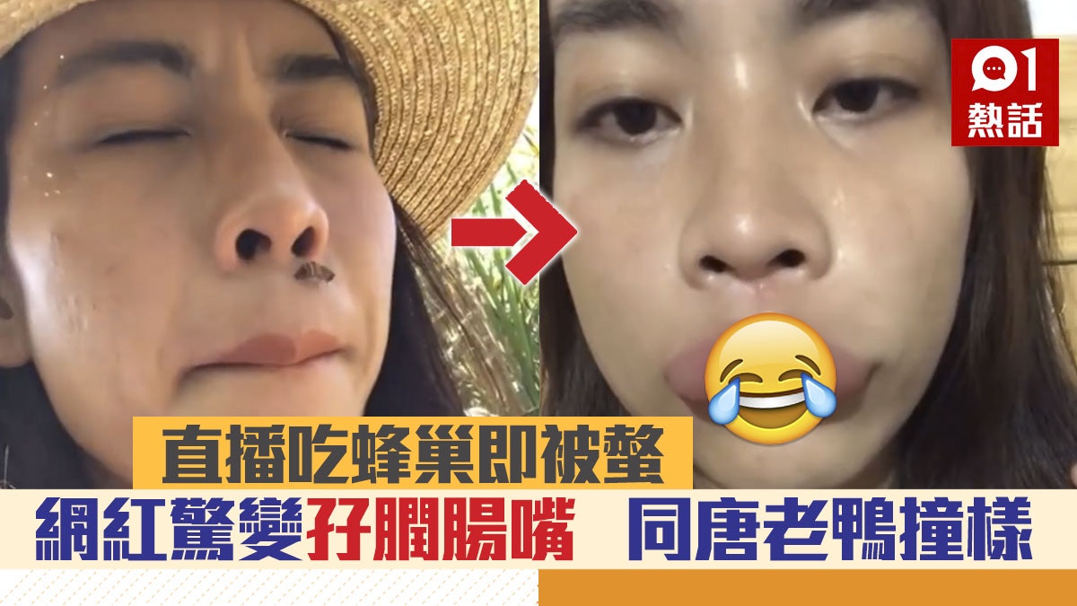 網紅為點擊率直播食野生蜂巢被螫 嘴唇驚變孖膶腸:飲水都漏 網紅為點擊率直播食野生蜂巢被螫 嘴唇驚變孖膶腸:飲水都漏