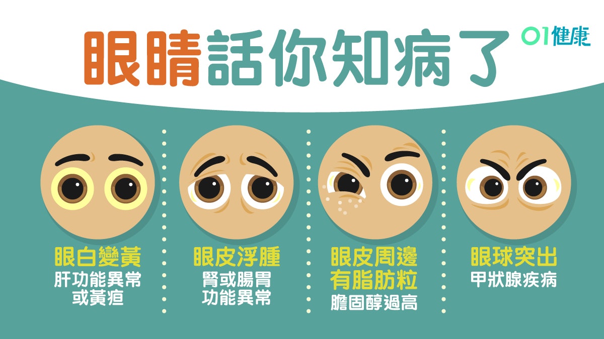 自我檢測|眼腫腎異常脂肪粒膽固醇高 6眼睛症狀即知貧血腸胃弱 自我檢測|眼腫腎異常脂肪粒膽固醇高 6眼睛症狀即知貧血腸胃弱
