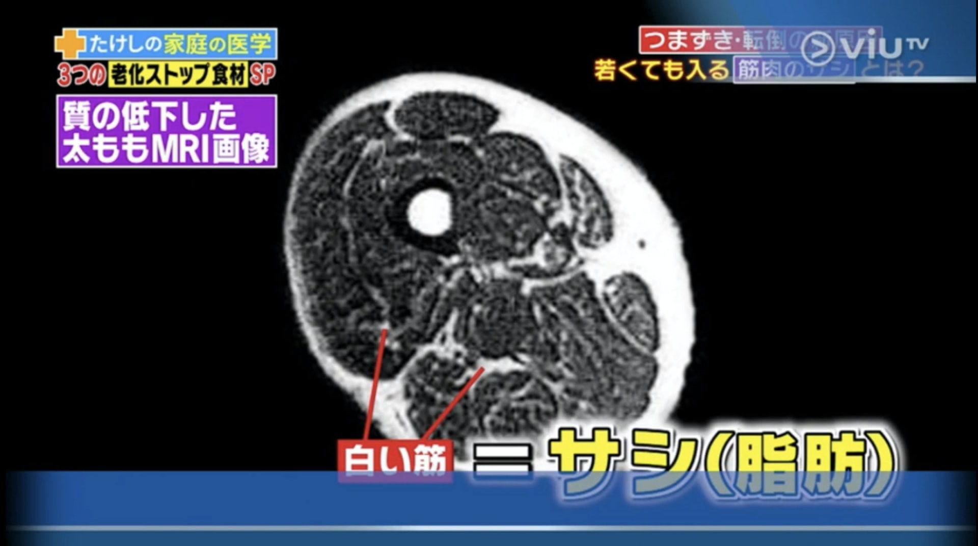 肌肉質素下降問題的人士的大腿肌肉中穿插了很多白色的「雪花」，其實就是積聚的脂肪。（Viu TV《恐怖醫學》影片截圖）