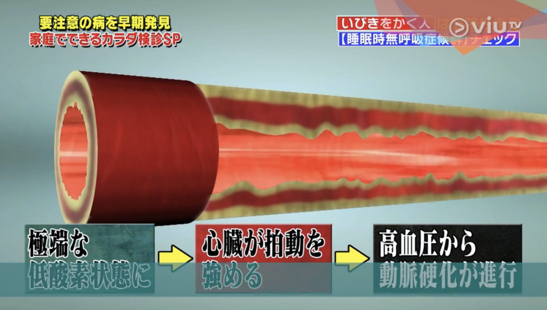 因此,睡眠時血壓會急劇上升,長遠就會加劇動脈硬化。(Viu TV《恐怖醫學》影片截圖) 因此,睡眠時血壓會急劇上升,長遠就會加劇動脈硬化。(Viu TV《恐怖醫學》影片截圖)