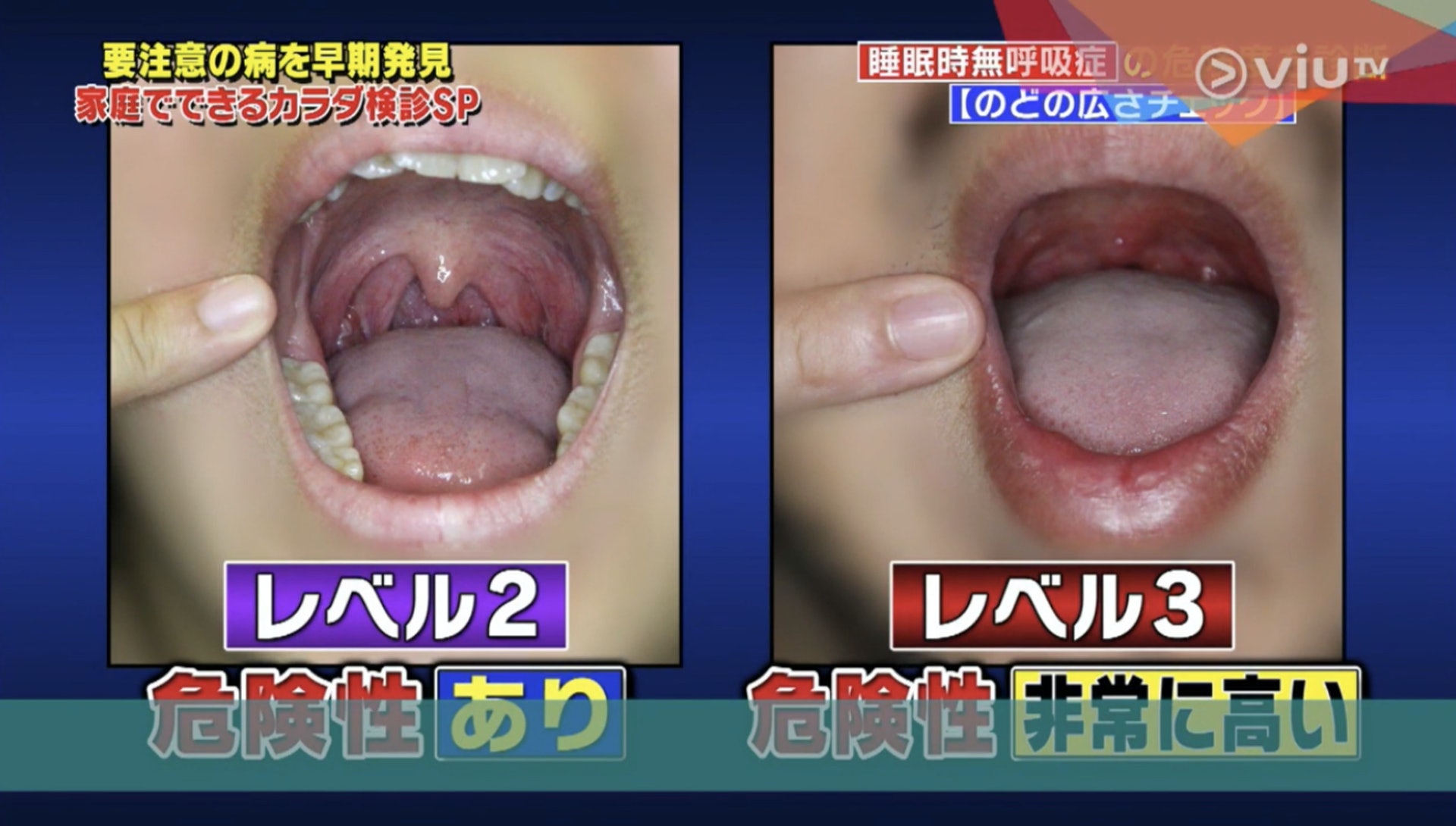 患睡眠窒息症風險較高的情況:左圖為2級的例圖,明顯未能達到1級的標準(Viu TV《恐怖醫學》影片截圖) 患睡眠窒息症風險較高的情況:左圖為2級的例圖,明顯未能達到1級的標準(Viu TV《恐怖醫學》影片截圖)