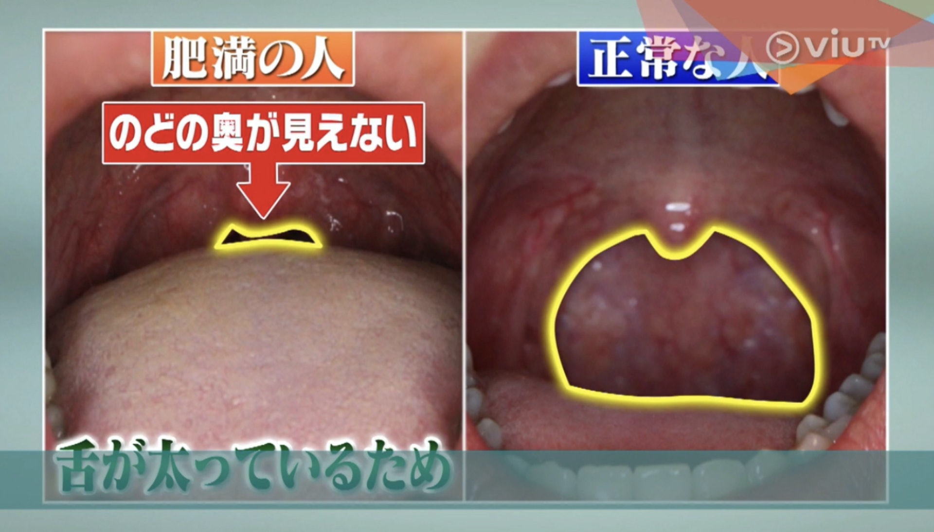 左圖為肥胖人士的口腔，右圖則為正常人的口腔，可見肥胖人士的氣道開口空間明顯少很多。（Viu TV《恐怖醫學》影片截圖）