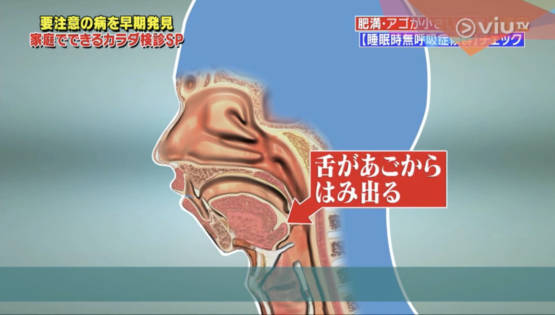下顎沒有足夠空間容納舌頭,令舌頭被擠到口腔裡面。(Viu TV《恐怖醫學》影片截圖) 下顎沒有足夠空間容納舌頭,令舌頭被擠到口腔裡面。(Viu TV《恐怖醫學》影片截圖)