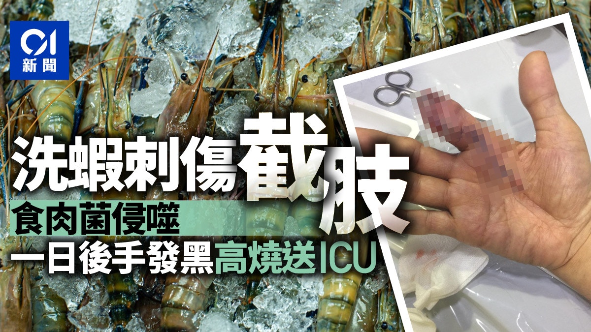 新加坡男洗蝦被刺傷　對小傷口不以為意　翌日終需截肢保命