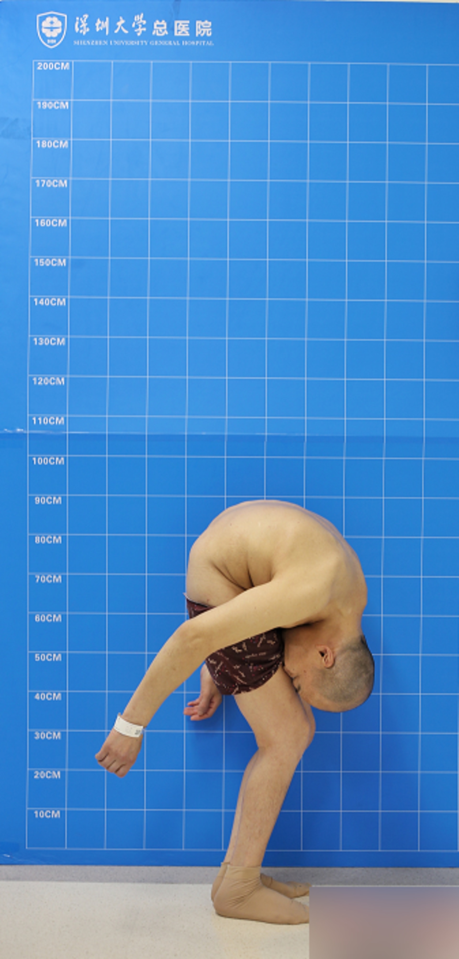自從患病以來,李華的身體更呈現完全摺疊狀態,無法直立行走或平躺睡覺。(網上圖片) 自從患病以來,李華的身體更呈現完全摺疊狀態,無法直立行走或平躺睡覺。(網上圖片)