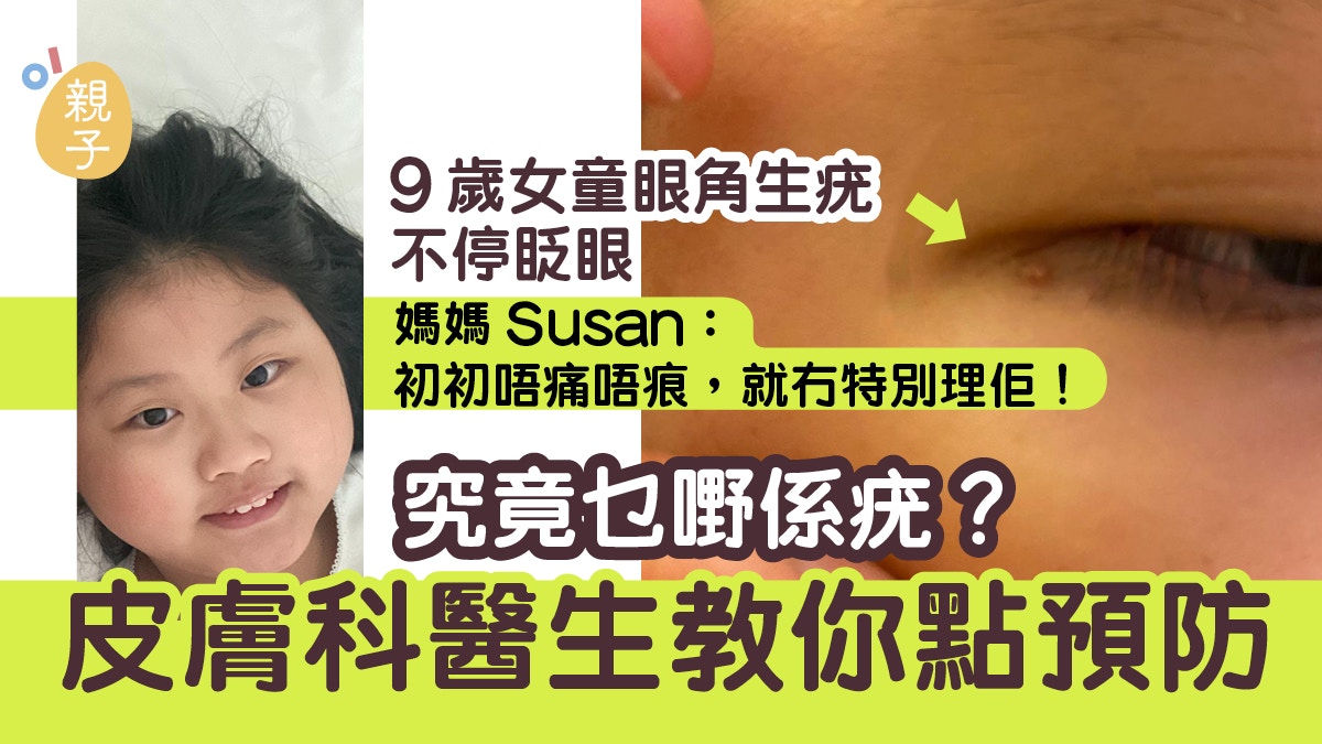 9歲女童眼角生疣不停眨眼醫生 小朋友抵抗力差擴散得快 香港01 親子