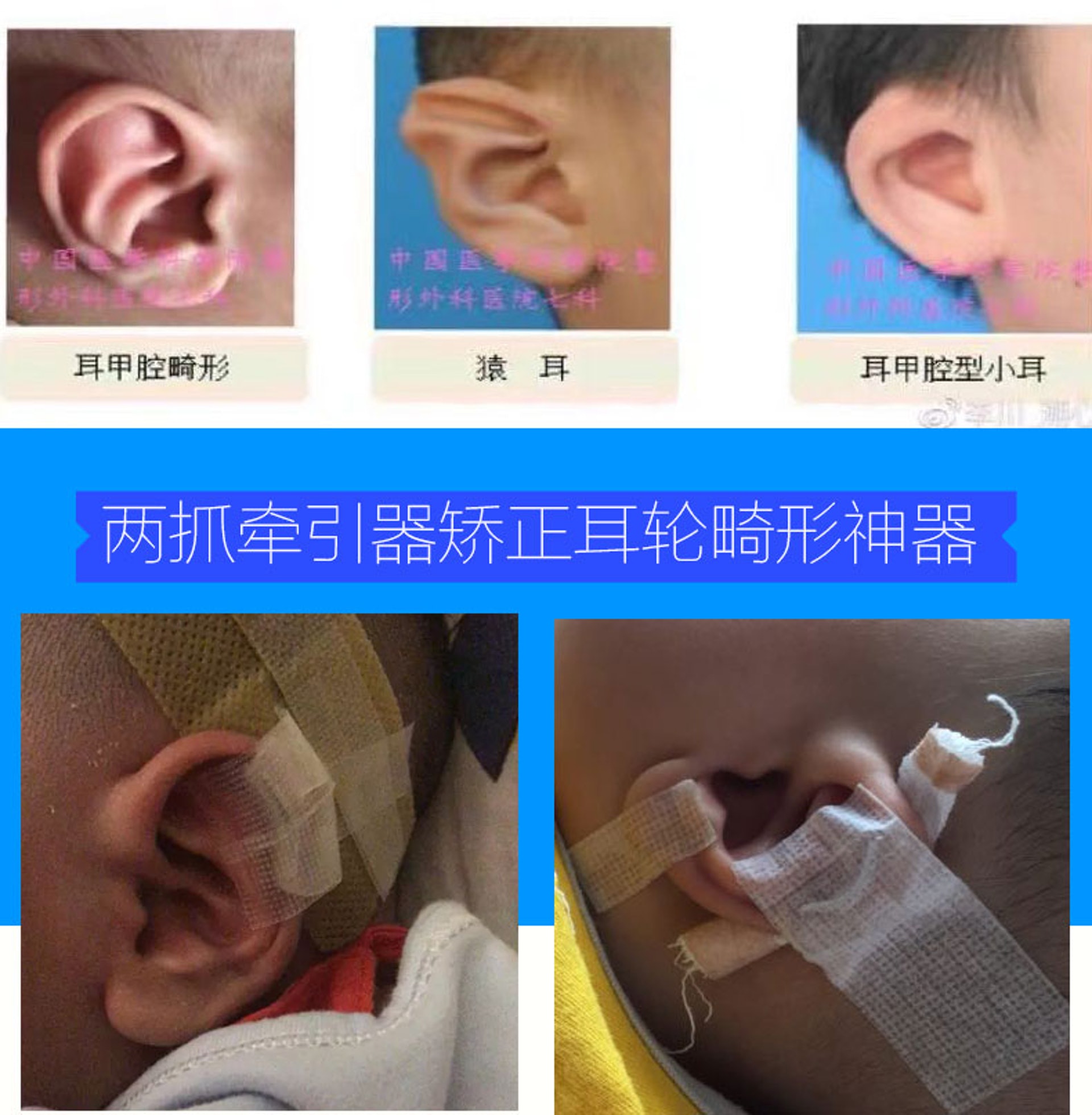 これら兜風耳手術 これら兜風耳手術