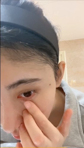 鞠婧禕不時撫摸眼部抱怨自己黑眼圈嚴重。(鞠婧禕@微博) 鞠婧禕不時撫摸眼部抱怨自己黑眼圈嚴重。(鞠婧禕@微博)