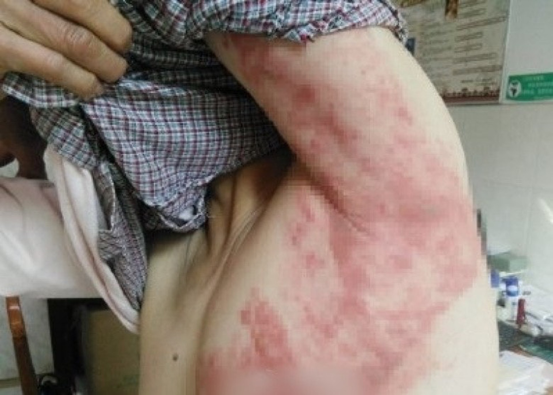 【「生蛇」及「水痘」病徵2】紅疹大概於5天內陸續出現。最初出現於身軀，然後向面部和四肢散布。（資料圖片）