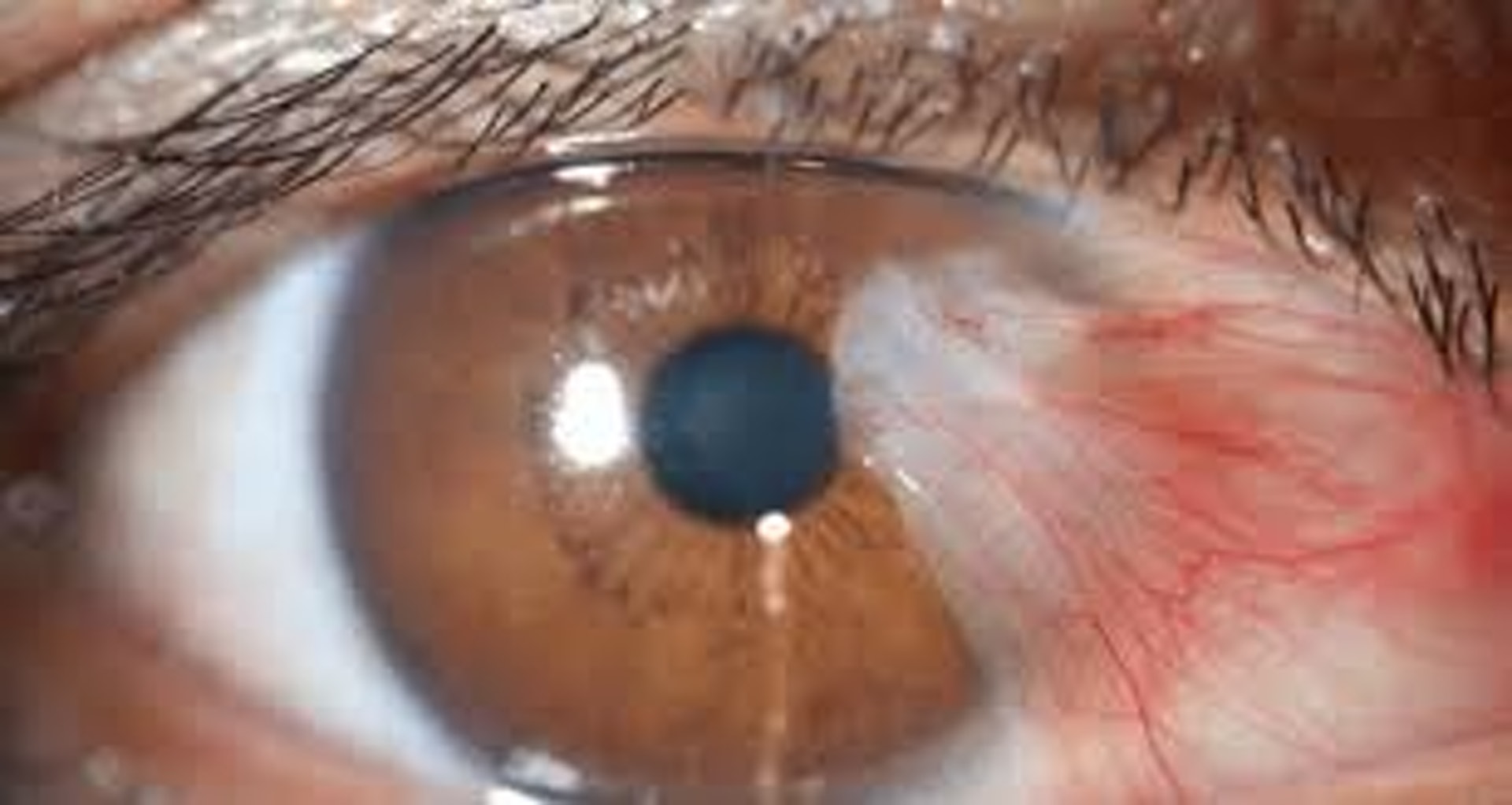 翼狀胬肉：患者通常會在眼白部分長出粉紅色、呈三角形的薄膜（撰稿人授權提供）