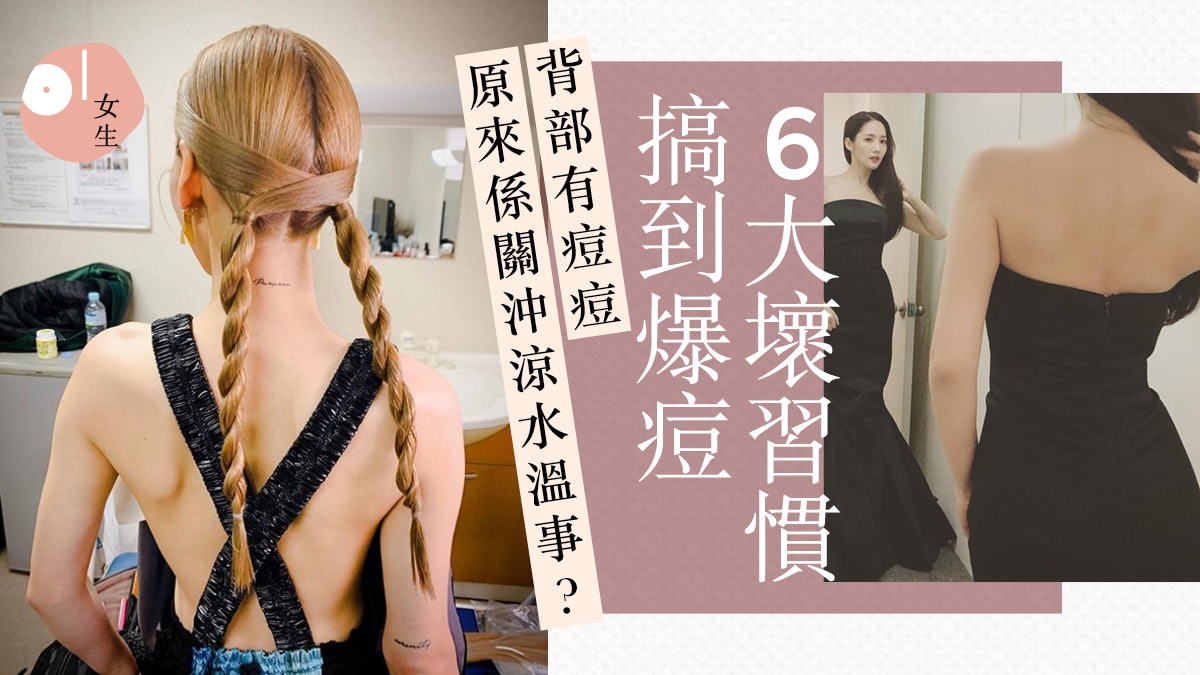 【背部護理】有背痘唔著得露背裝?戒除6個壞習慣:沖涼都關事? 【背部護理】有背痘唔著得露背裝?戒除6個壞習慣:沖涼都關事?
