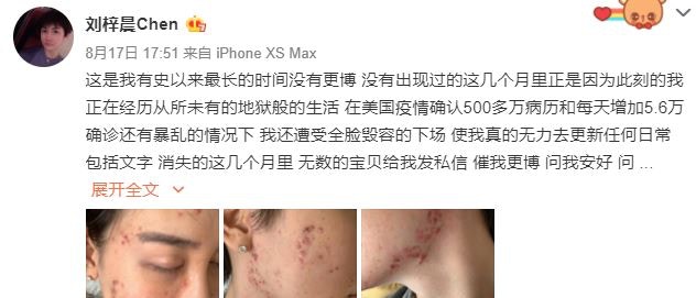 蛇精男劉梓晨出事消失3個月po恐怖自拍驚喊 全臉毀容了 香港01 熱爆話題