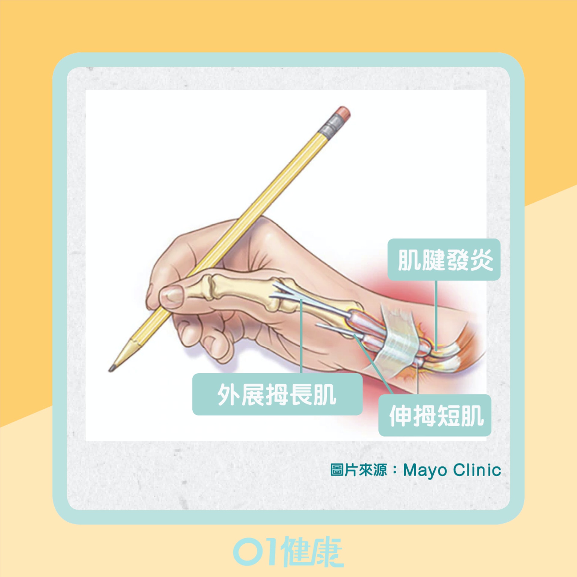 狹窄性拇指肌腱滑膜炎(01製圖) 狹窄性拇指肌腱滑膜炎(01製圖)