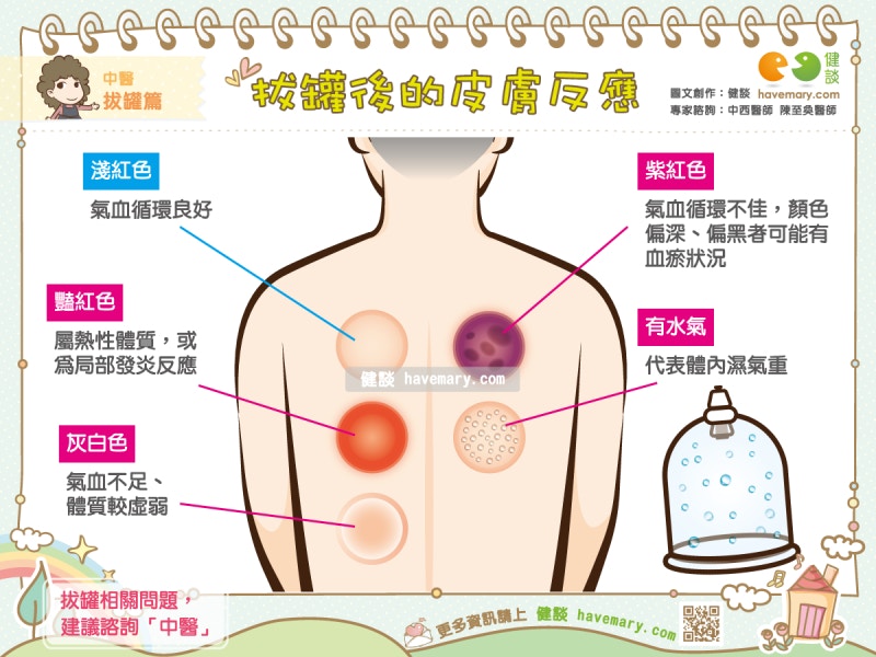 拔罐後的皮膚反應（健談授權使用）