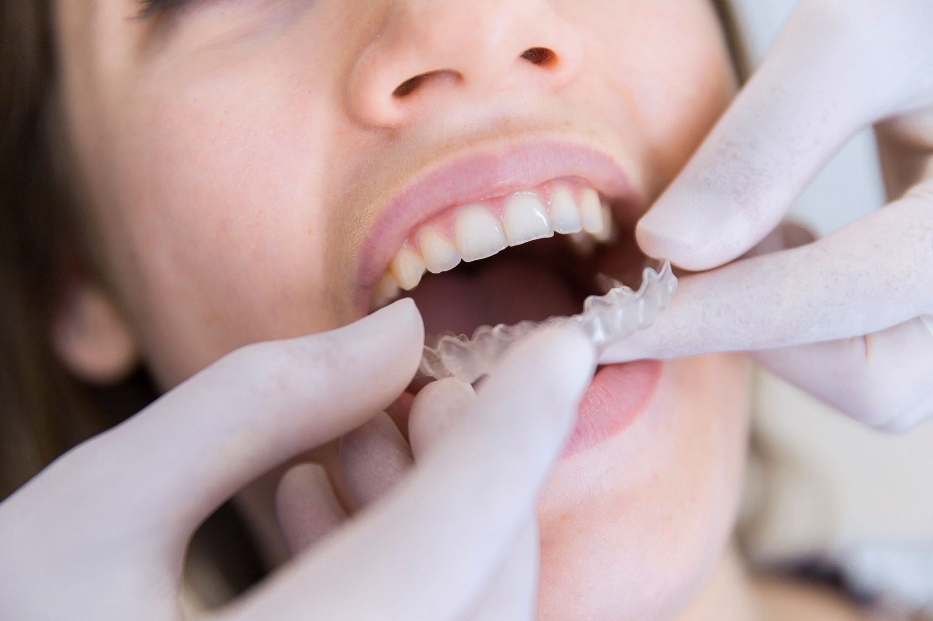 箍牙前必須接受牙醫的專業健康評估及分析。(圖片: Freepik)