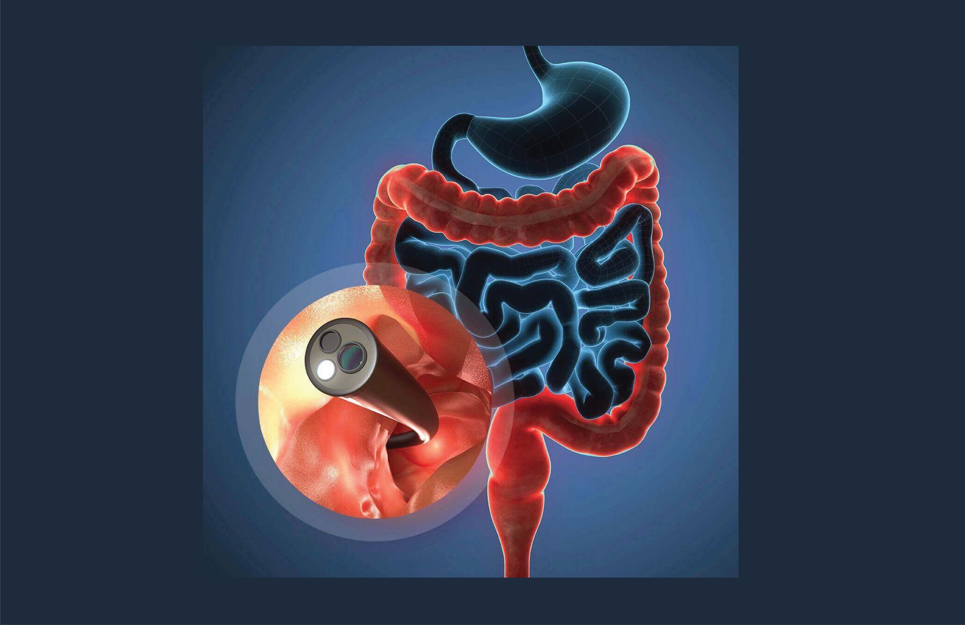 想有效預防大腸癌,就須主動、定期進行檢查。(圖片:Colorectal Practice) 想有效預防大腸癌,就須主動、定期進行檢查。(圖片:Colorectal Practice)
