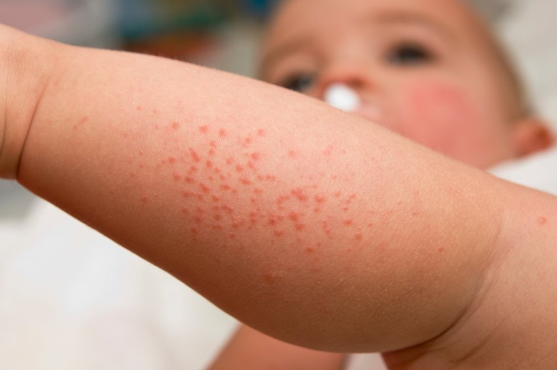小兒濕疹的生長位置普遍會發生於四肢、關節之間的連接位。（圖片：Fullerskin）