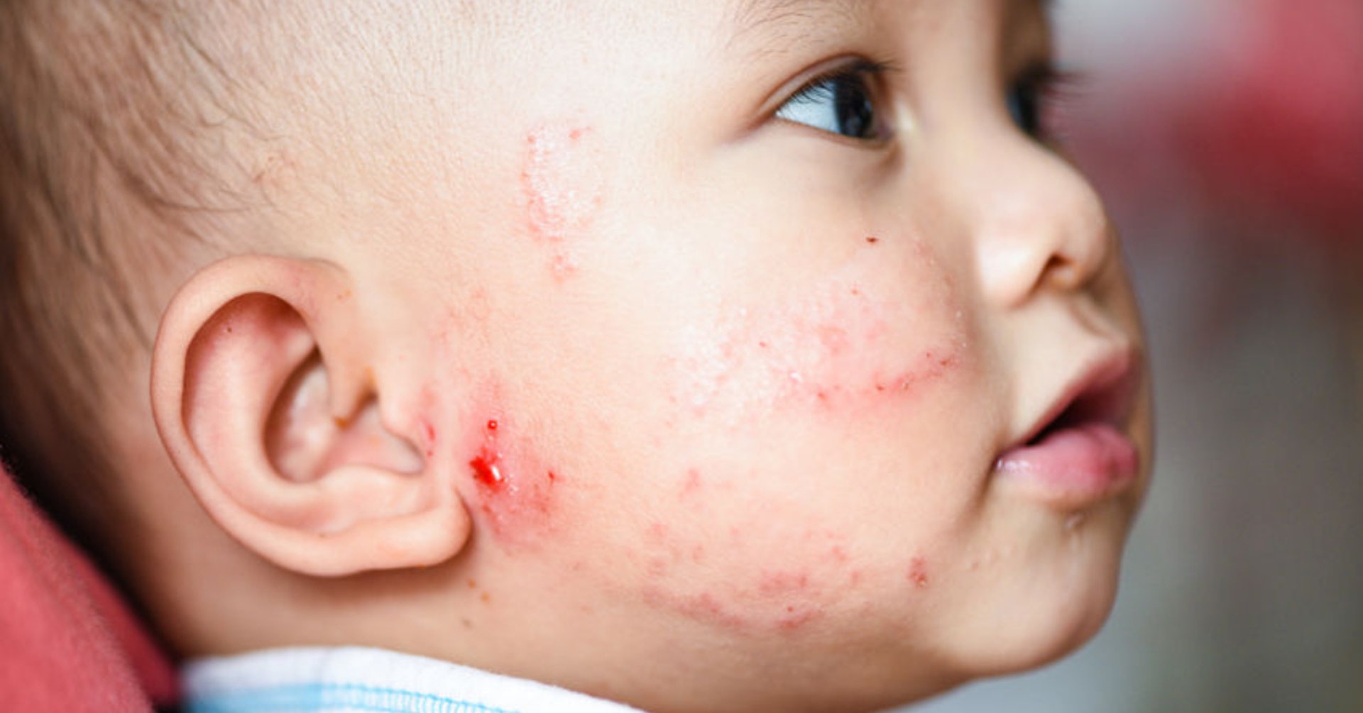 雖然濕疹使小朋友痕癢、流血，但並不會傳染。（圖片：Getty Images）