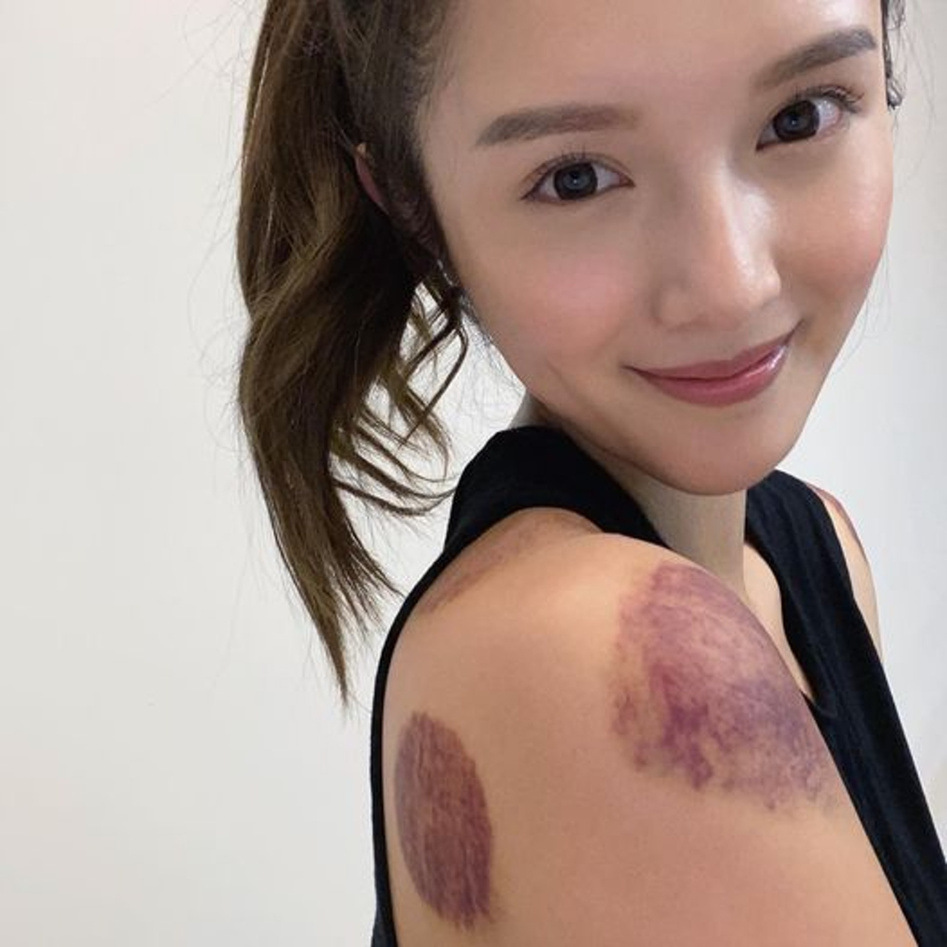 鄺潔楹(Judy)拍攝劍擊戲後接受拔罐留下深黑瘀痕(Facebook:Judy Kwong 鄺潔楹) 鄺潔楹(Judy)拍攝劍擊戲後接受拔罐留下深黑瘀痕(Facebook:Judy Kwong 鄺潔楹)
