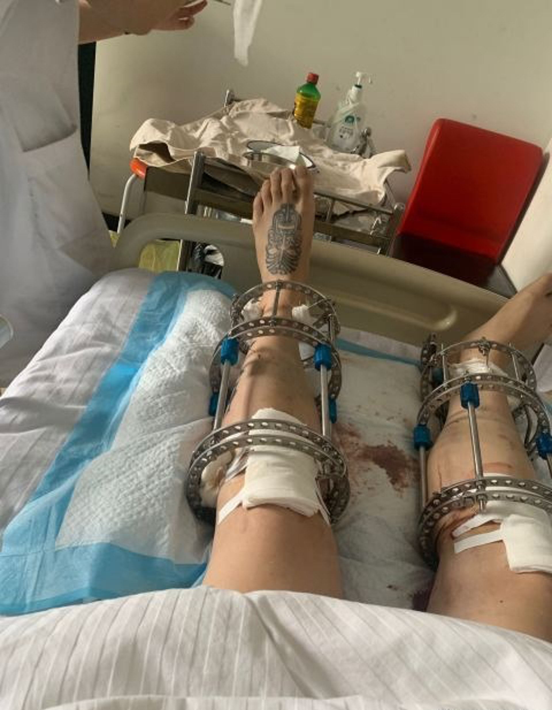 男事主接受斷骨增高手術,惟術後卻產生嚴重副作用。(微博圖片/示意圖) 男事主接受斷骨增高手術,惟術後卻產生嚴重副作用。(微博圖片/示意圖)