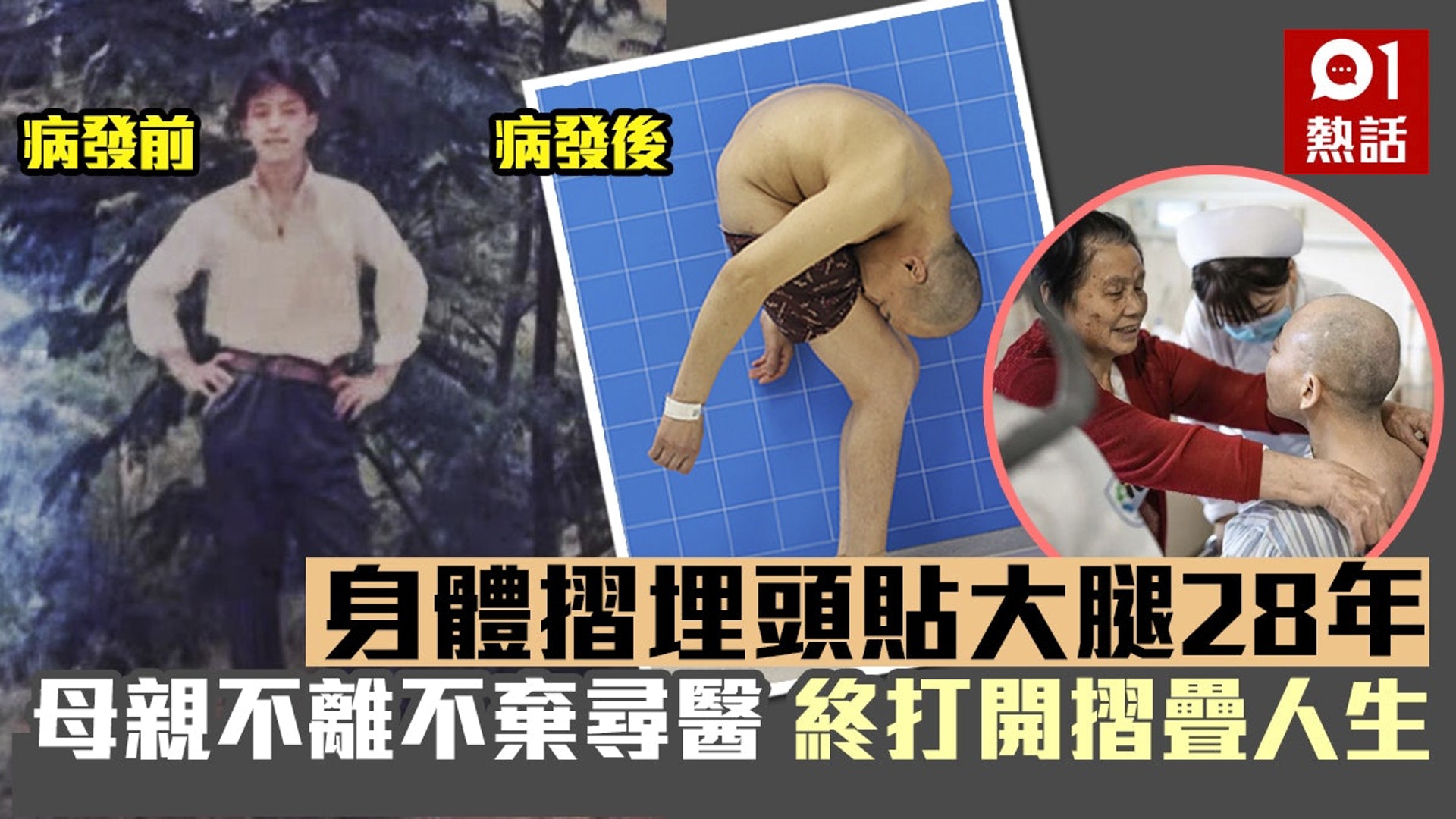 湖南省1名男子18歲時確診罕見的強直性脊柱炎,脊骨逐漸彎曲,身體如同「摺疊」,母親從來沒有放棄病兒,近年帶他到深圳大學總醫院接受治療,經過4次「粉身碎骨」的手術,兒子終於再次站起來。的。(01製圖) 湖南省1名男子18歲時確診罕見的強直性脊柱炎,脊骨逐漸彎曲,身體如同「摺疊」,母親從來沒有放棄病兒,近年帶他到深圳大學總醫院接受治療,經過4次「粉身碎骨」的手術,兒子終於再次站起來。的。(01製圖)
