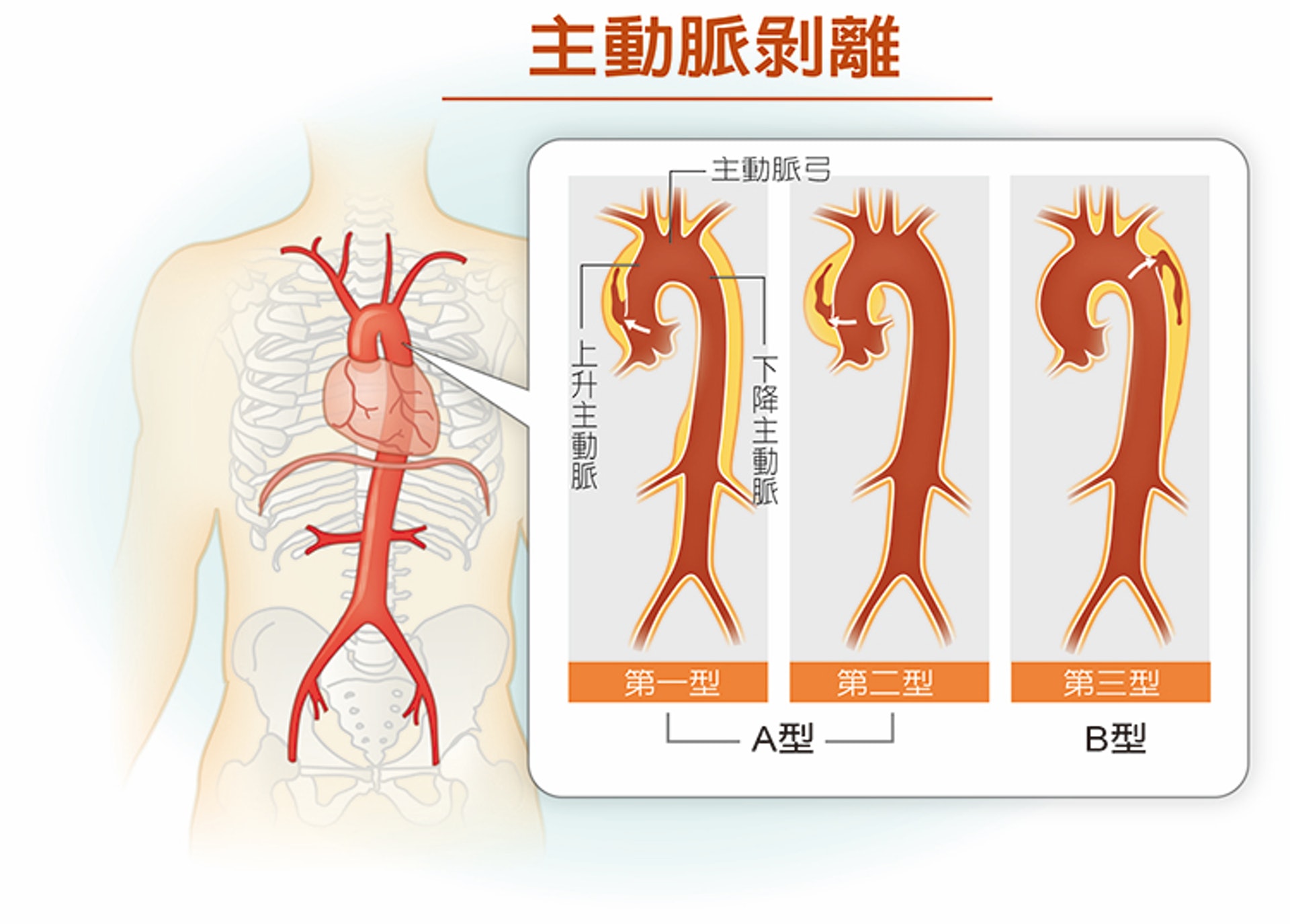 主動脈剝離亦有分兩個類型。（圖片：twhealth）