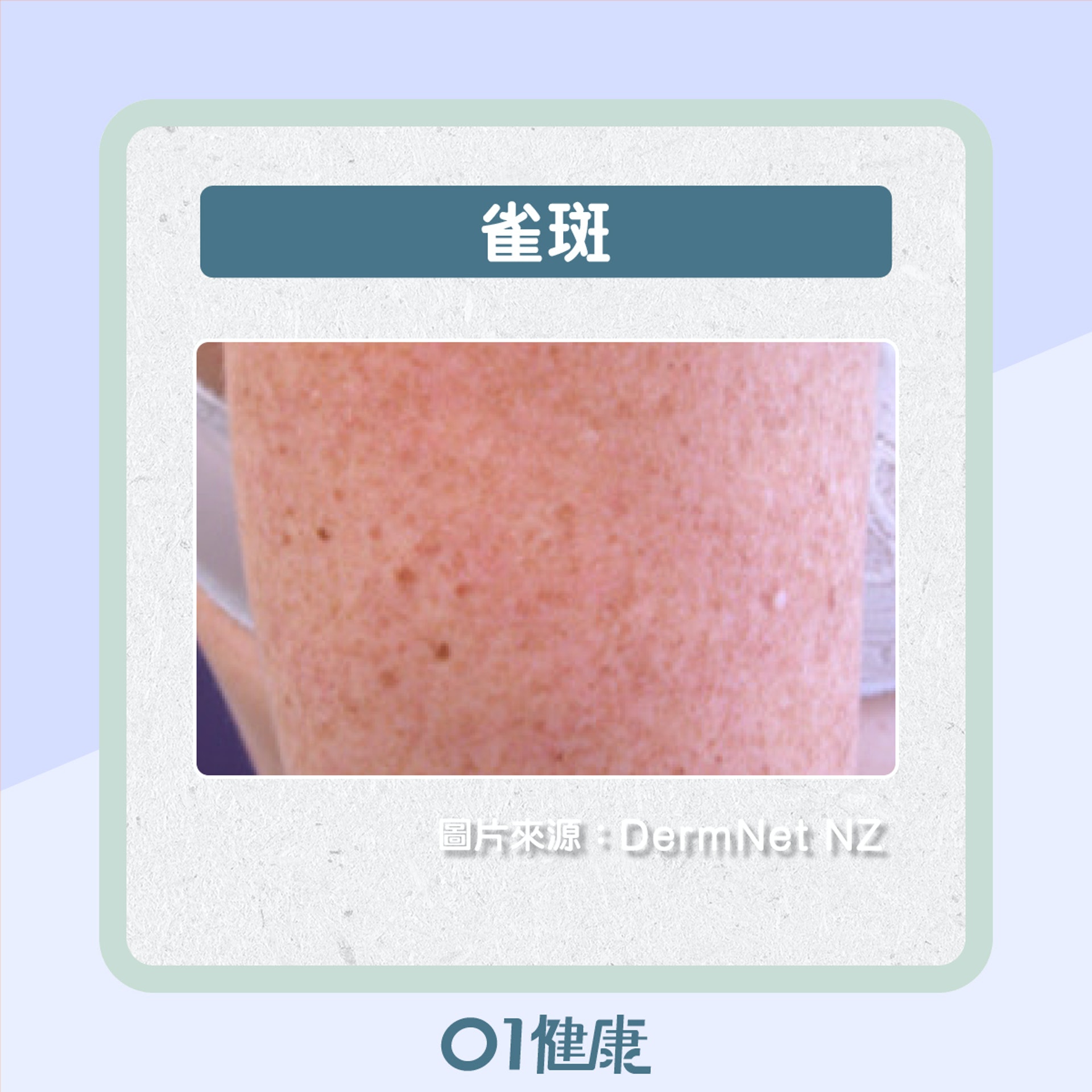 如何分辨不同的色斑?(01製圖) 如何分辨不同的色斑?(01製圖)