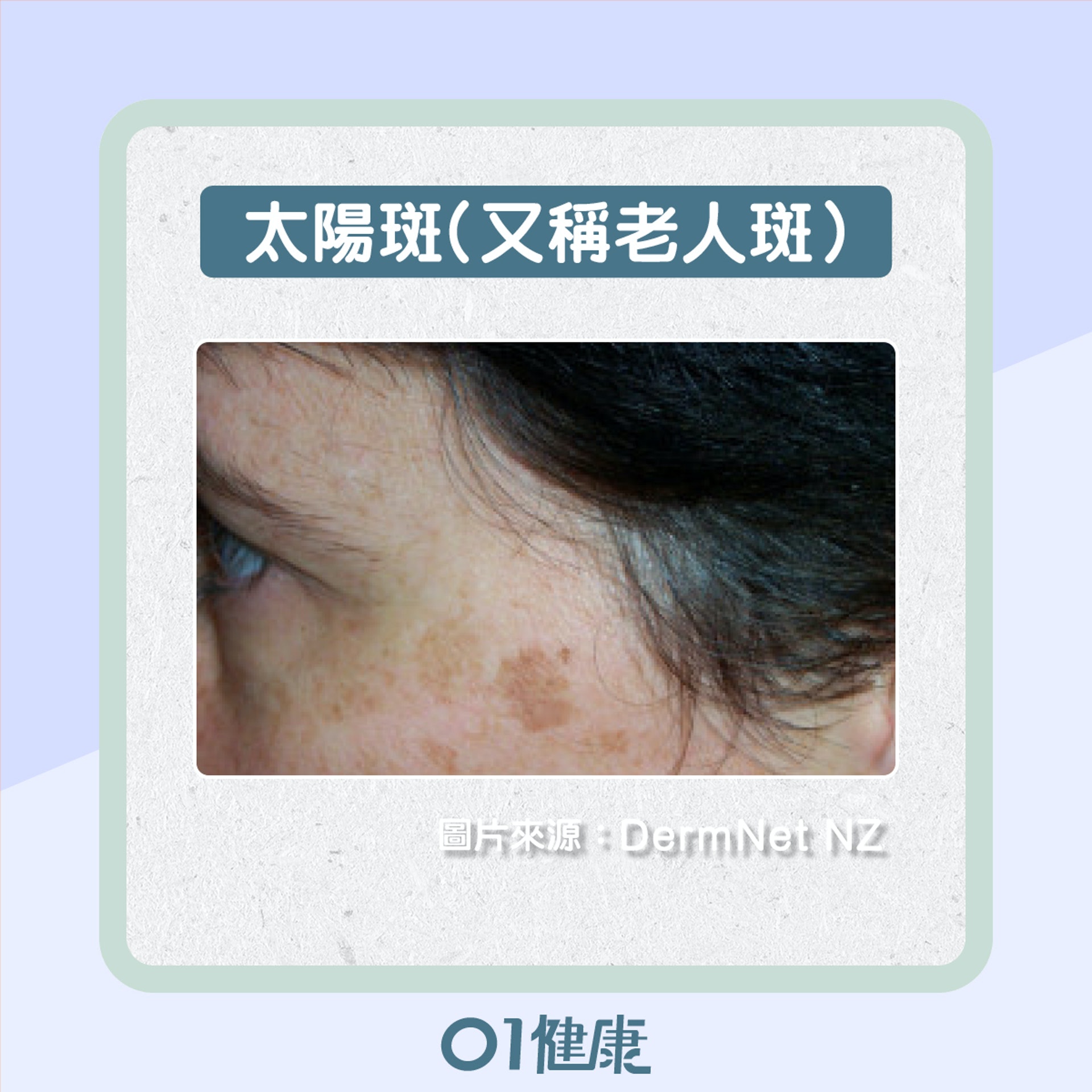 如何分辨不同的色斑?(01製圖) 如何分辨不同的色斑?(01製圖)