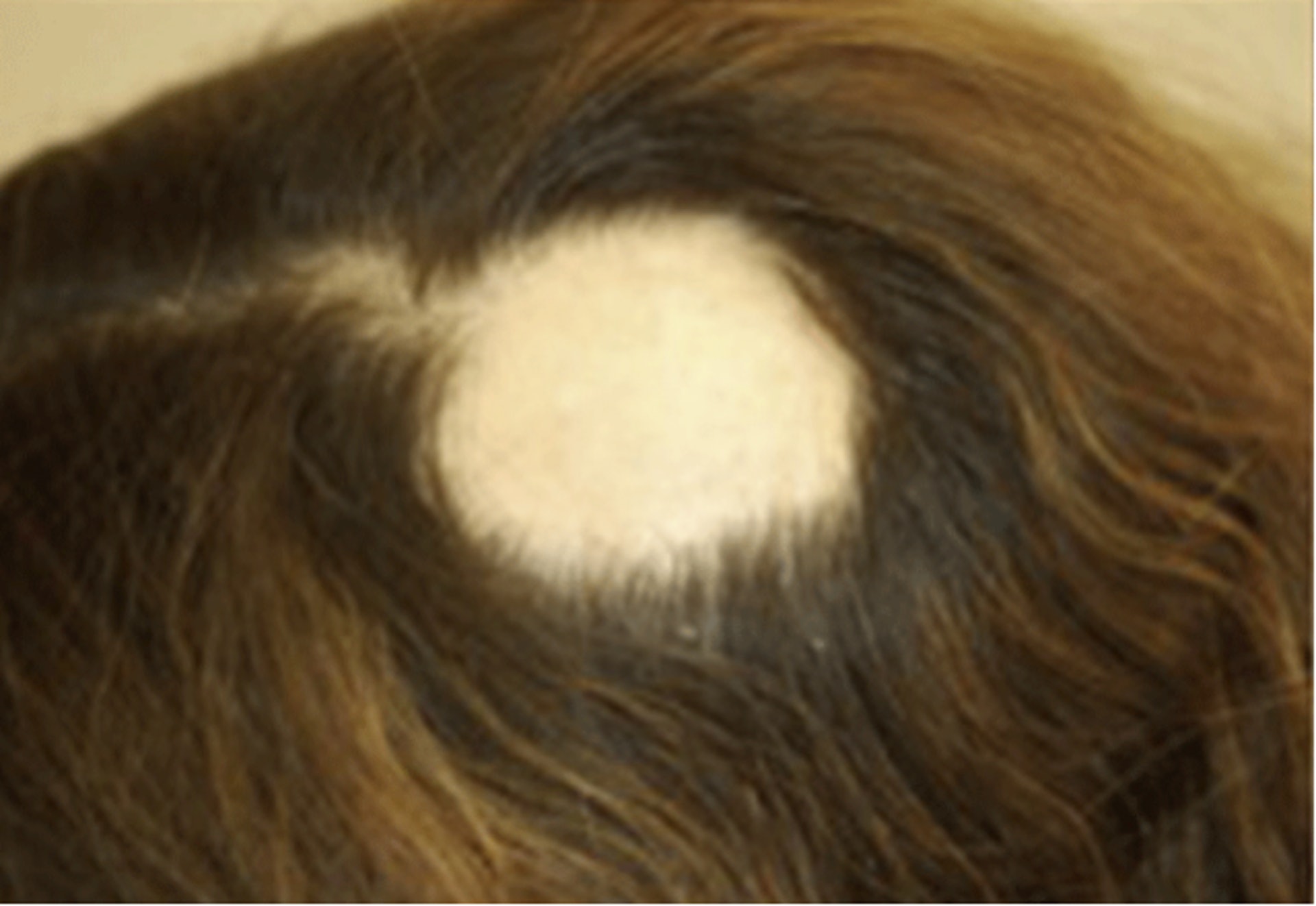 鬼剃頭，即是斑禿。一般出現如硬幣大小的禿髮情況，嚴重會有大片面積的脫髮。（照片來自American Academy of Dermatology Association ）
