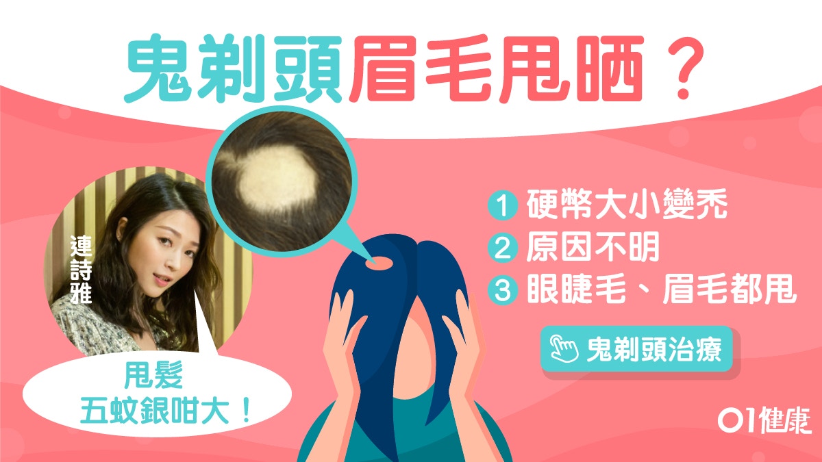 鬼剃頭 連詩雅鬼剃頭5蚊咁大 斑禿8疑問眼眉睫毛甩埋點醫好