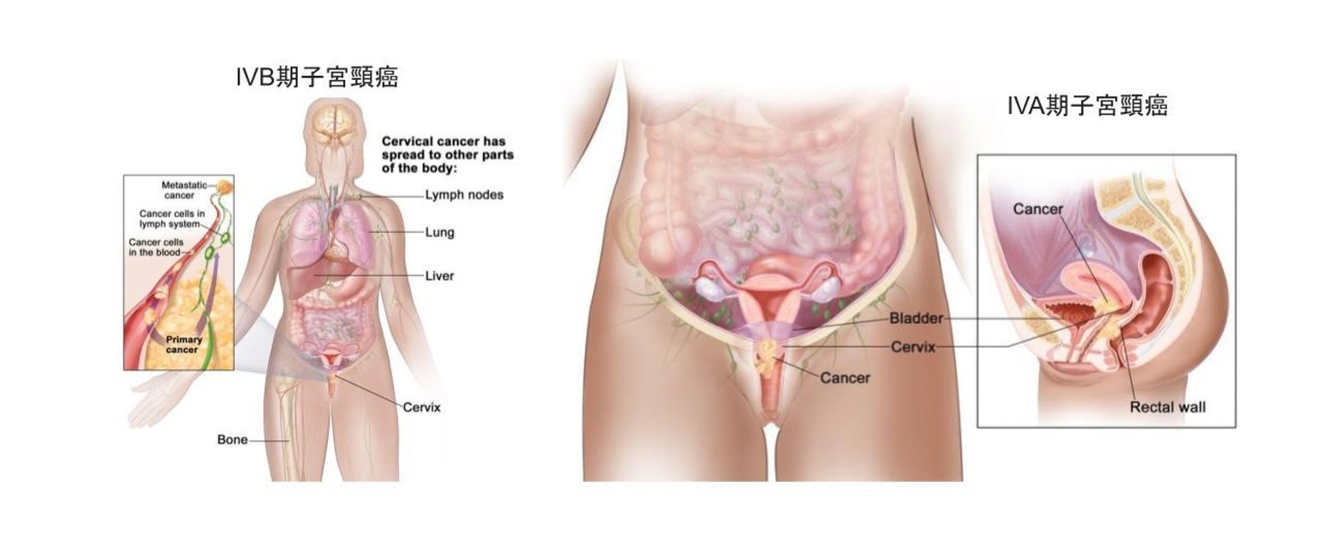子宮頸癌的分期。（圖片由張天怡醫生提供。）
