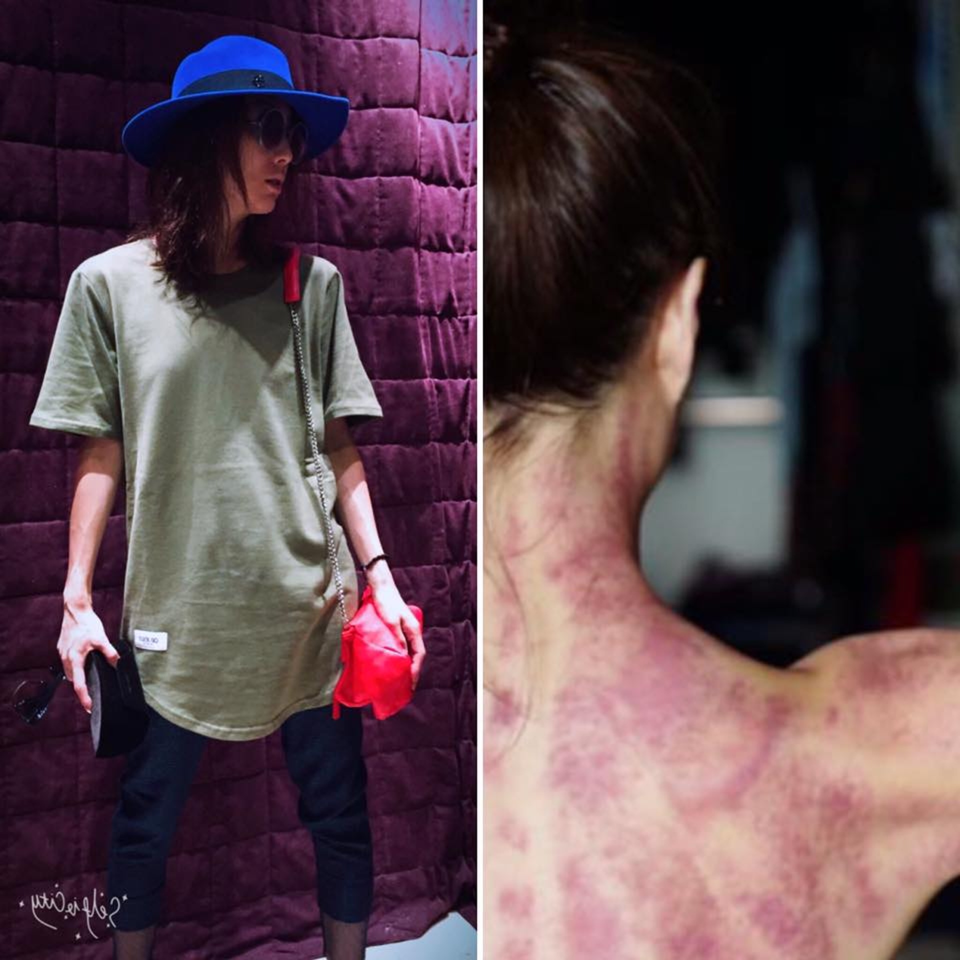 藝人鄭秀文曾表示刮痧後，後頸背部都刮出紫紅色瘀痕。（圖片來源：鄭秀文 Sammi Cheng Facebook截圖）