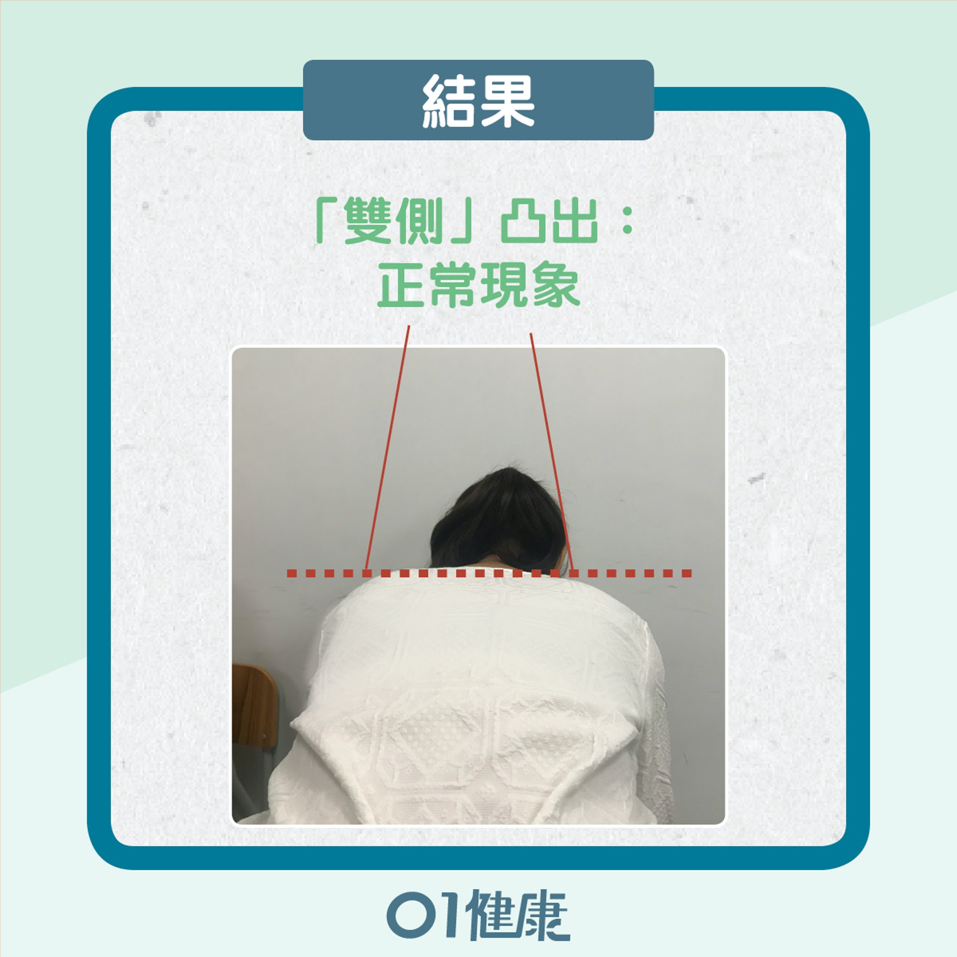 自我檢測脊椎側彎(01製圖) 自我檢測脊椎側彎(01製圖)